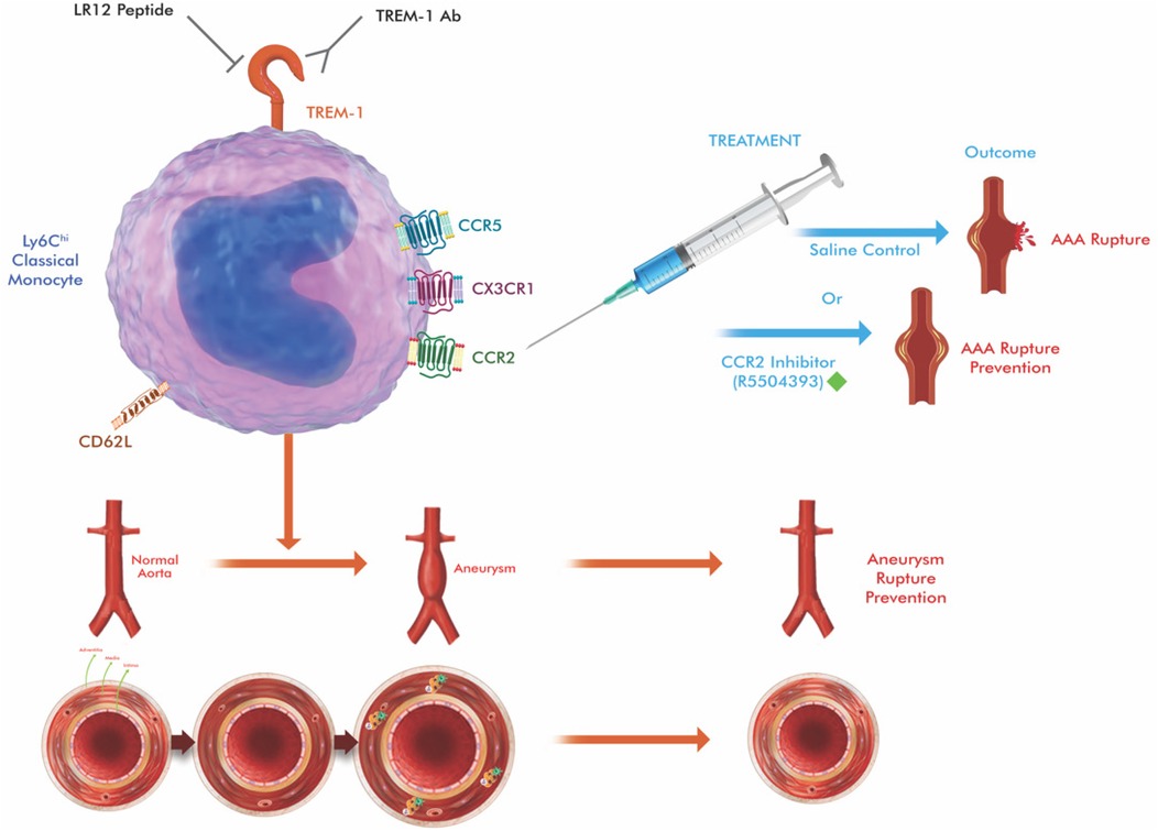 Illustration of a Ly6Chi classical monocyte with receptors TREM-1, CCR5, CX3CR1, and CCR2. Treatment options include saline control or the CCR2 Inhibitor, showing outcomes of AAA rupture or prevention. The progression from a normal aorta to an aneurysm and then to rupture prevention is depicted, highlighting the impact of treatments.
