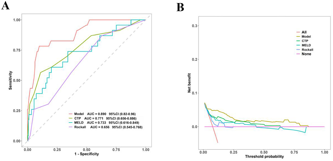 Panel A shows a Receiver Operating Characteristic (ROC) curve comparing different models: Model (AUC = 0.890), CTP (AUC = 0.771), MELD (AUC = 0.733), and Rockall (AUC = 0.656). Panel B presents a Decision Curve Analysis indicating net benefit across threshold probabilities for models All, Model, CTP, MELD, Rockall, and None.