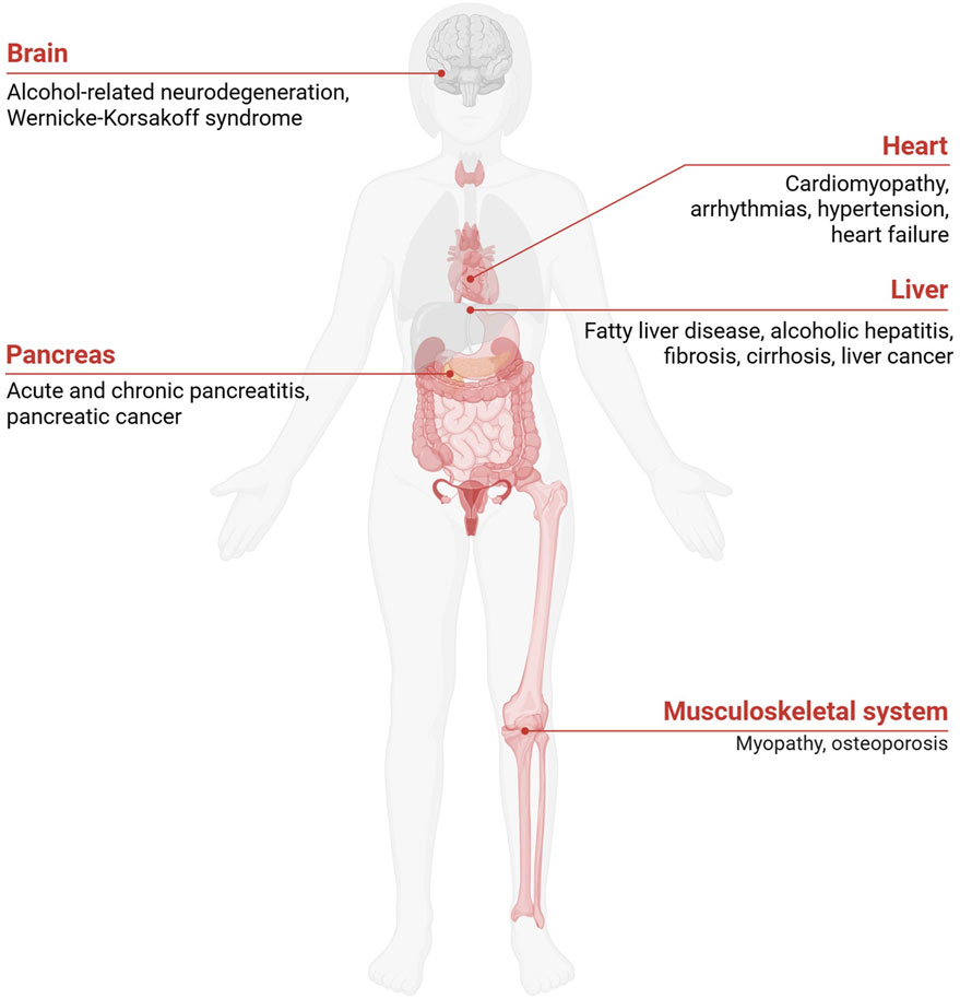Illustration of a human body highlighting the effects of alcohol on five systems. Brain: alcohol-related neurodegeneration, Wernicke-Korsakoff syndrome. Heart: cardiomyopathy, arrhythmias, hypertension, heart failure. Liver: fatty liver disease, alcoholic hepatitis, fibrosis, cirrhosis, liver cancer. Pancreas: acute and chronic pancreatitis, pancreatic cancer. Musculoskeletal system: myopathy, osteoporosis.