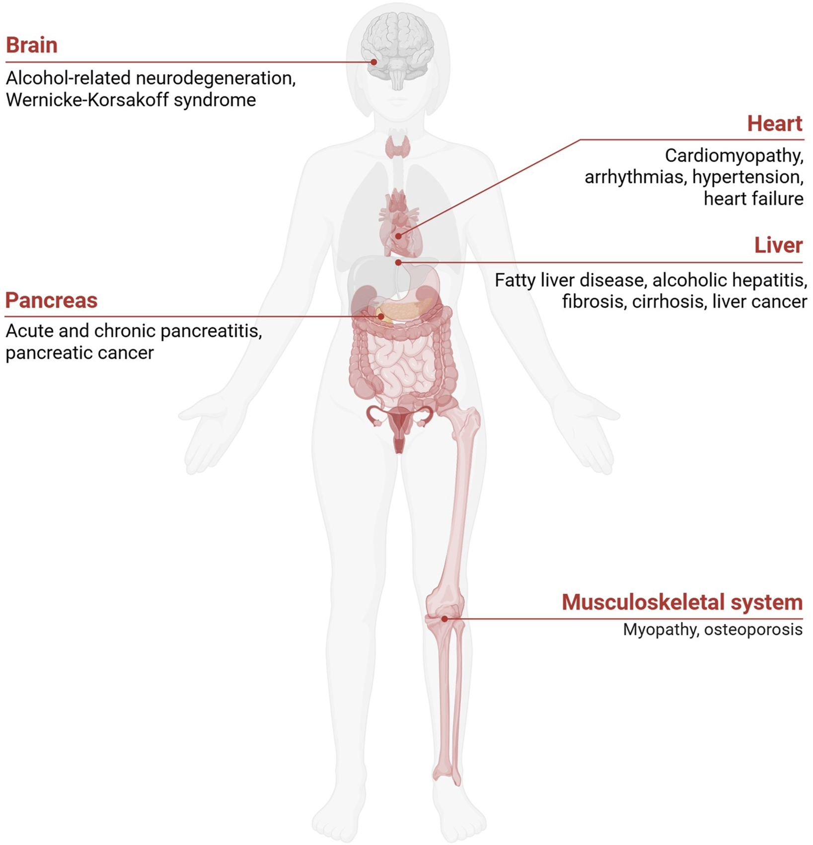 Illustration of a human body highlighting the effects of alcohol on five systems. Brain: alcohol-related neurodegeneration, Wernicke-Korsakoff syndrome. Heart: cardiomyopathy, arrhythmias, hypertension, heart failure. Liver: fatty liver disease, alcoholic hepatitis, fibrosis, cirrhosis, liver cancer. Pancreas: acute and chronic pancreatitis, pancreatic cancer. Musculoskeletal system: myopathy, osteoporosis.