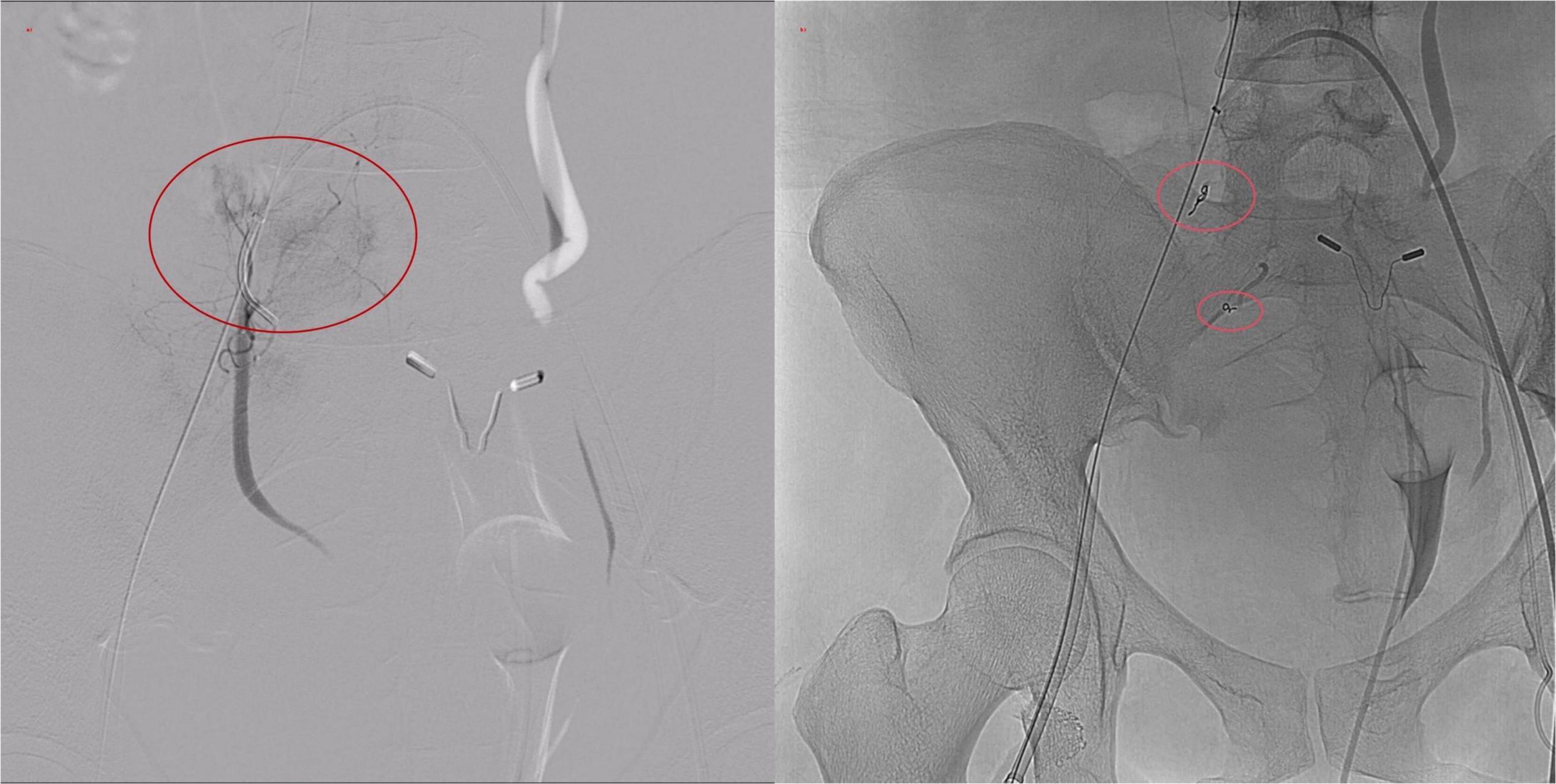 Two DSA images depicting angiographic findings in the pelvic region, with key areas circled in red. The left image shows pre-embolization findings, while the right image demonstrates post-embolization findings.