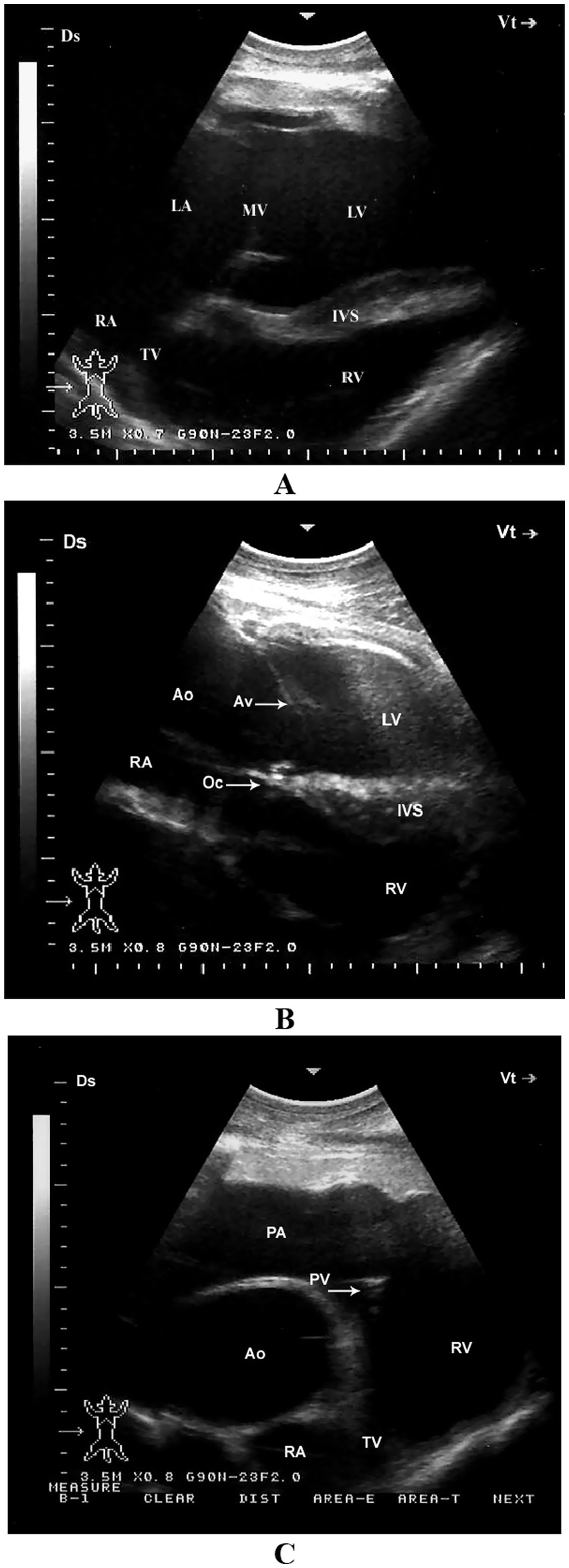Ultrasound images of the heart in three different views. Image A shows the left atrium (LA), mitral valve (MV), left ventricle (LV), right atrium (RA), tricuspid valve (TV), interventricular septum (IVS), and right ventricle (RV). Image B highlights the aorta (Ao), aortic valve (Av), left ventricle (LV), right atrium (RA), interventricular septum (IVS), and right ventricle (RV). Image C displays the pulmonary artery (PA), pulmonary valve (PV), aorta (Ao), right atrium (RA), tricuspid valve (TV), and right ventricle (RV).