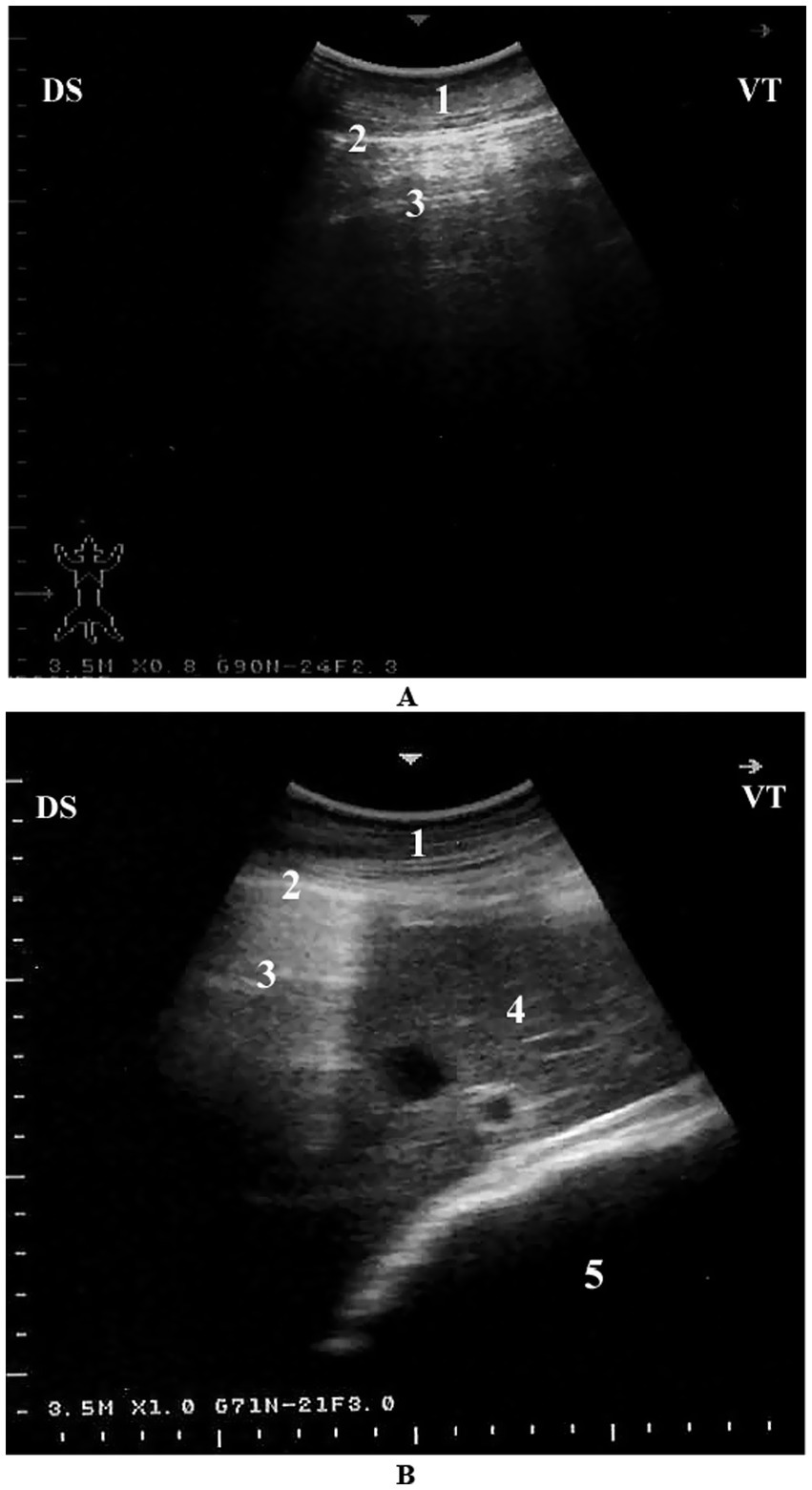 Ultrasound images labeled A and B. Image A shows three numbered areas: 1, 2, and 3, indicating different tissue sections. Image B includes five numbered areas: 1, 2, 3, 4, and 5, highlighting various structures within the ultrasound. Both images feature technical annotations at the edges.
