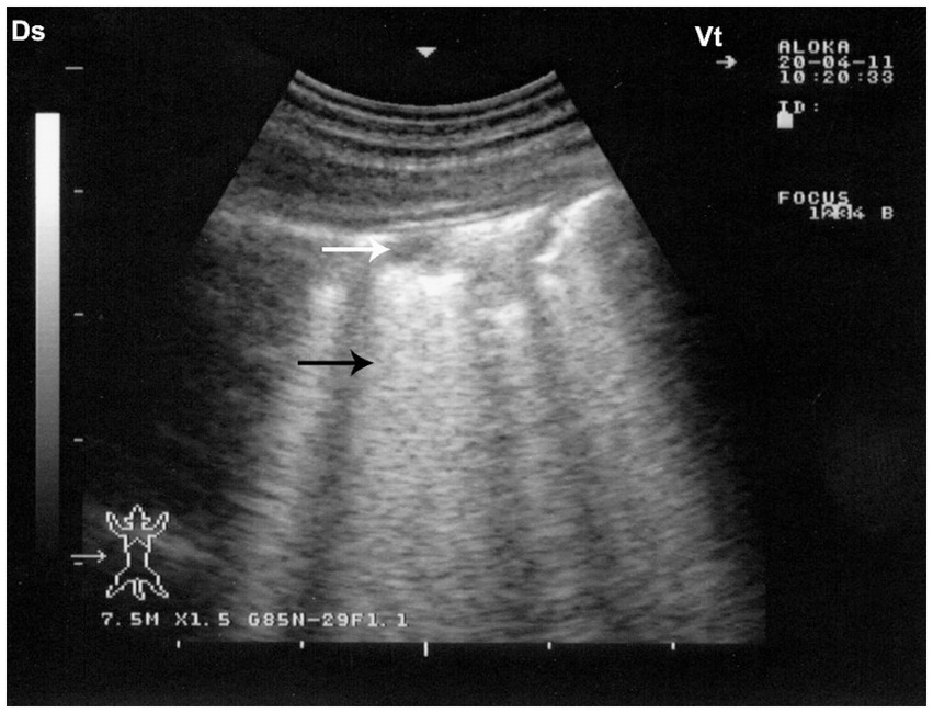 Ultrasound image showing vertical white lines on a dark background, likely lung ultrasound findings. A white arrow points to one line and a black arrow points to another. Numbers and indicators are present on the edges of the image.