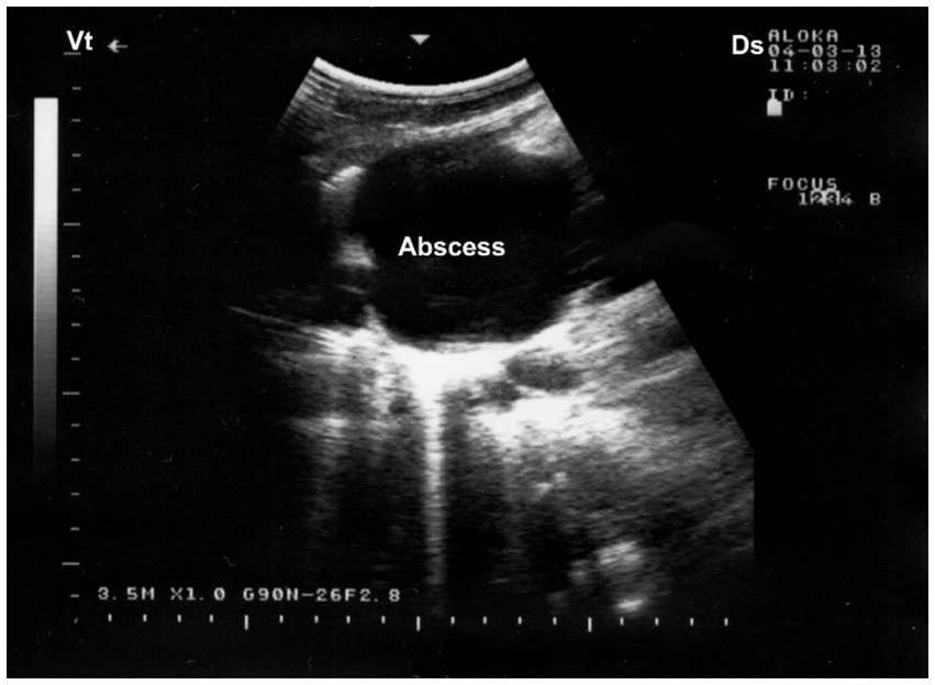 Ultrasound image showing a hypoechoic area labeled as