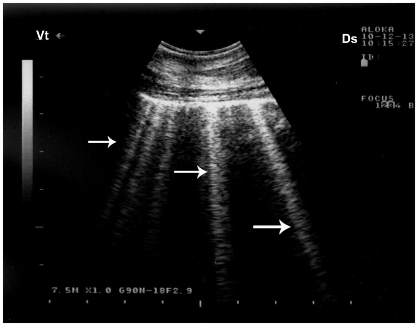 Black and white ultrasound image showing B-lines, which are vertical, fan-like lines originating from the pleural line, indicated by arrows. The display includes technical details and measurements.