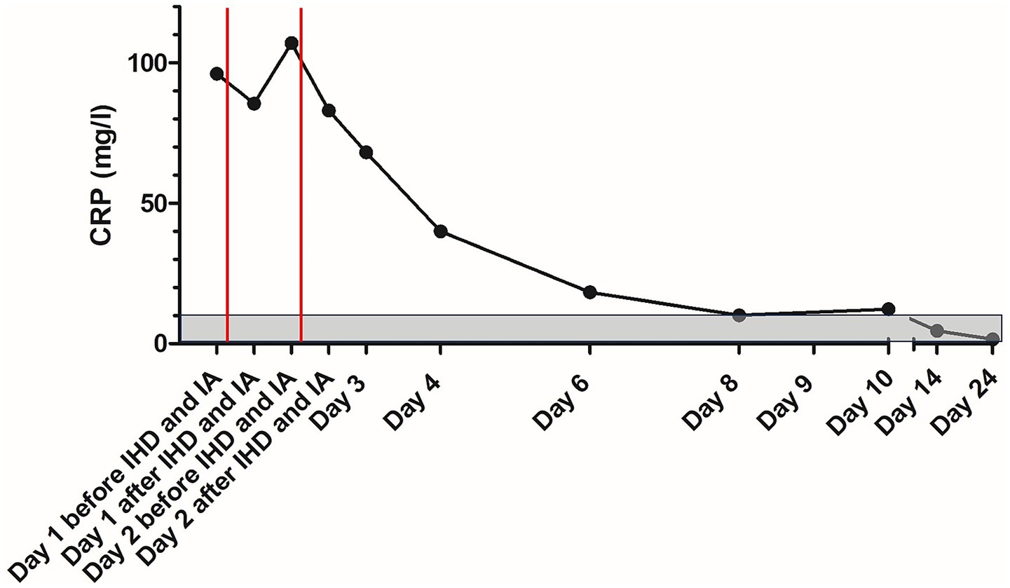 Graph showing CRP levels in milligrams per liter over 24 days, with levels starting above 100, spiking on Day 2, and gradually decreasing to about 0 by Day 24. Two red lines mark Days 1 and 2. Days are noted as pre and post IHD and IA procedures.
