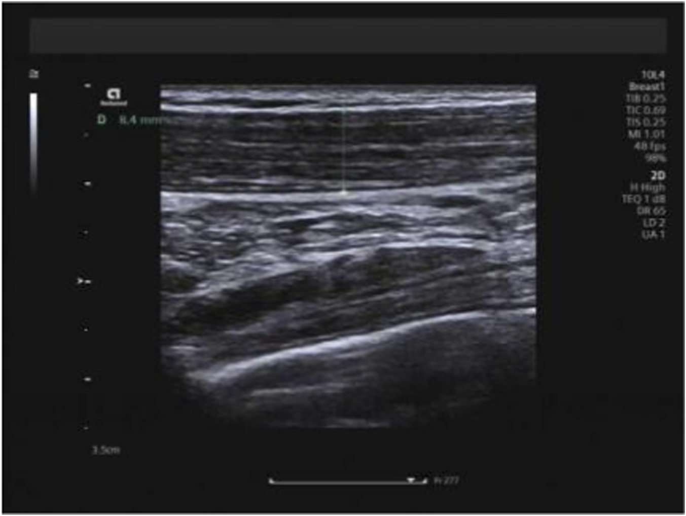 B-mode ultrasound image showing measurement of trapezius muscle thickness. The transducer is placed transversely over the right upper trapezius, and calipers indicate the perpendicular distance between the superficial and deep fascia used to quantify muscle thickness.