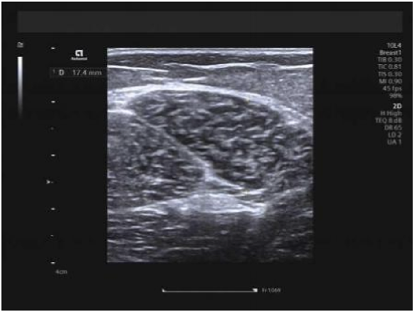 B-mode ultrasound image illustrating measurement of thickness of the long head of the biceps femoris. The transducer is positioned transversely over the muscle belly, with calipers marking the vertical distance between superficial and deep fascial borders.
