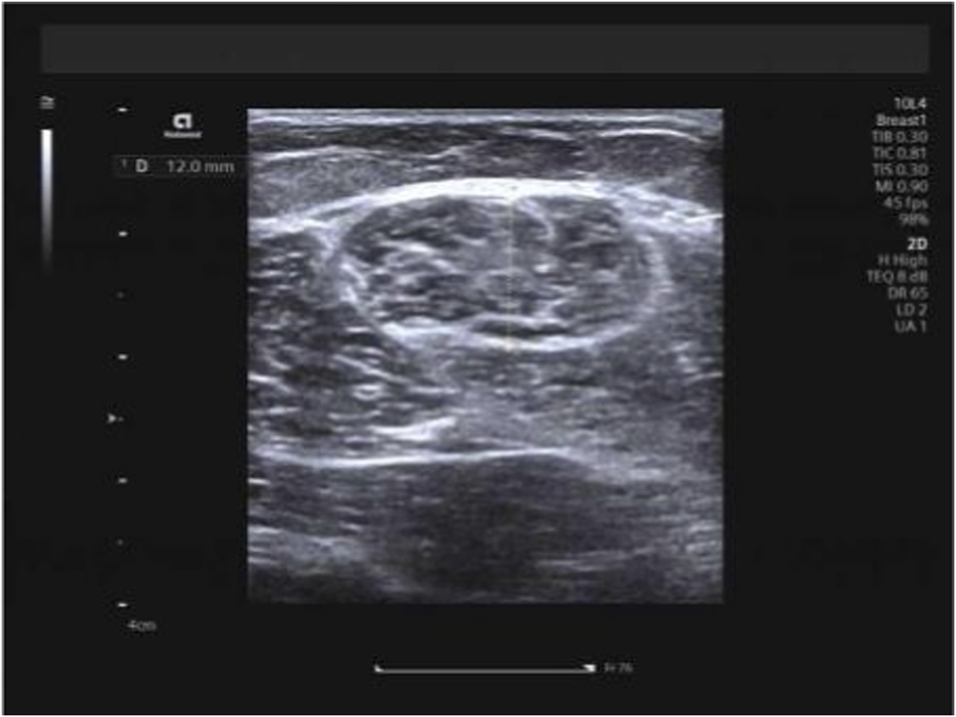 B-mode ultrasound image depicting measurement of semitendinosus muscle thickness. The probe is oriented transversely at the mid-belly of the muscle, and calipers indicate the distance between superficial and deep fascia.