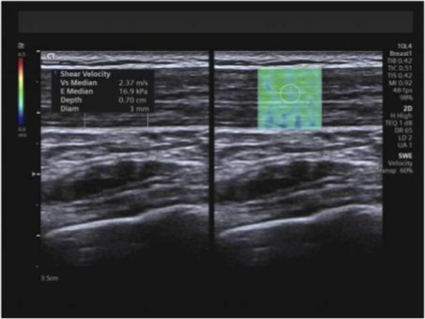 Shear-wave elastography image showing measurement of mean Young’s modulus (Emean) and mean shear-wave velocity (SWVmean) in the trapezius muscle. A color elastography map is overlaid on the grayscale image, with a circular region of interest placed within the muscle.