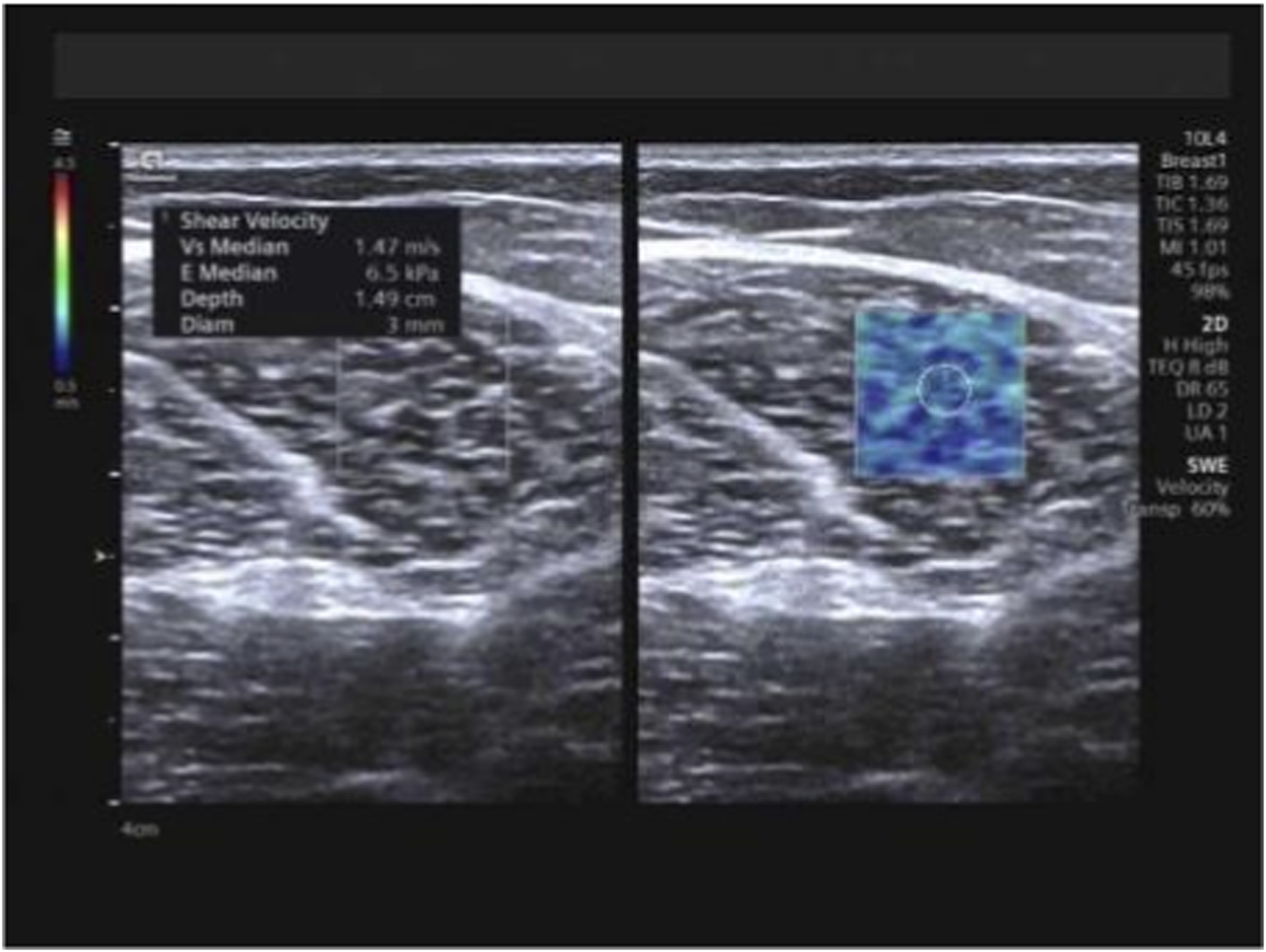 Shear-wave elastography image illustrating measurement of mean Young’s modulus (Emean) and mean shear-wave velocity (SWVmean) in the long head of the biceps femoris. A color-coded stiffness map and a defined region of interest are displayed within the muscle belly.