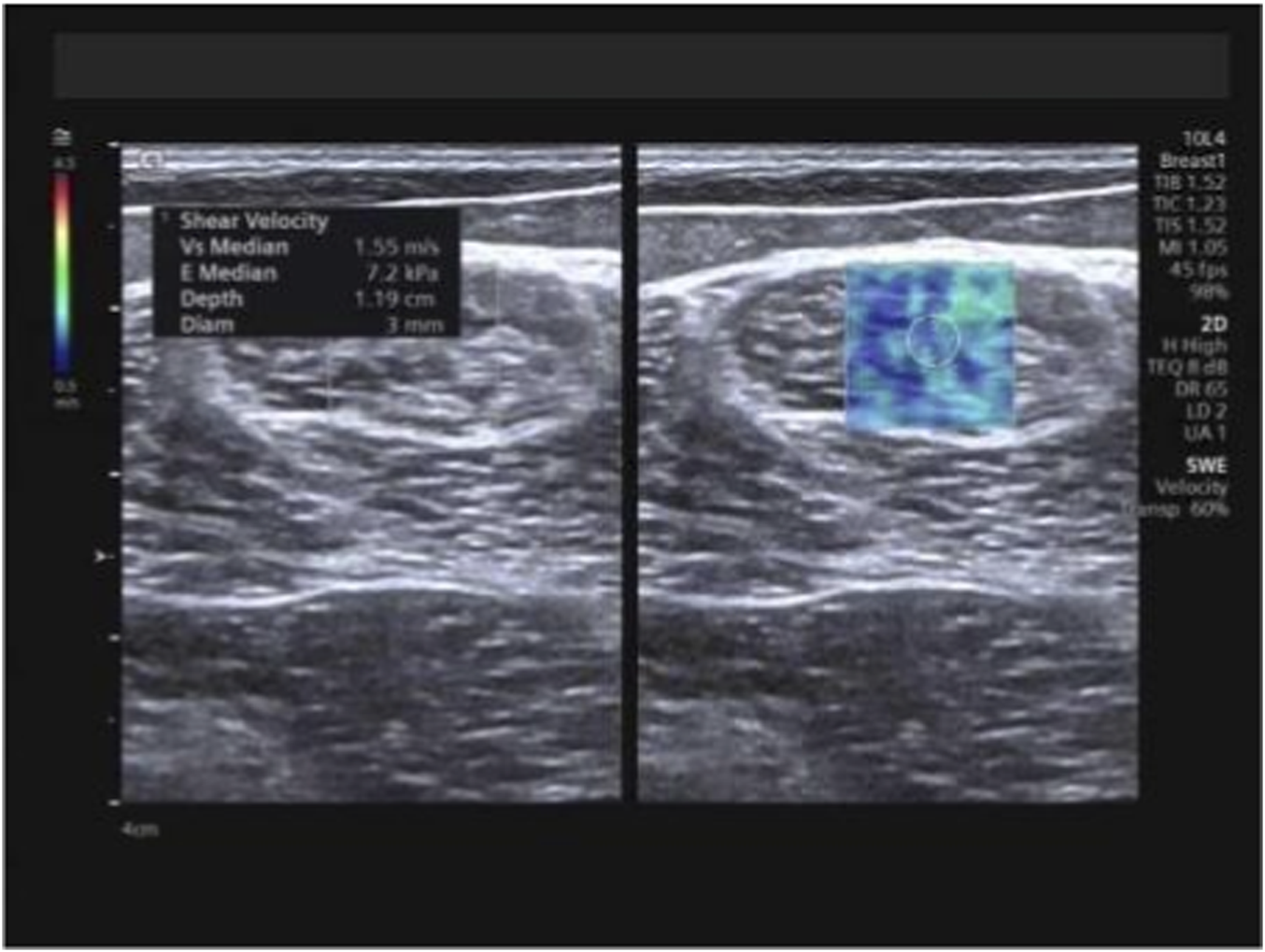 Shear-wave elastography image showing measurement of mean Young’s modulus (Emean) and mean shear-wave velocity (SWVmean) in the semitendinosus muscle. The image includes a color elastography overlay and a circular region of interest positioned within the muscle.