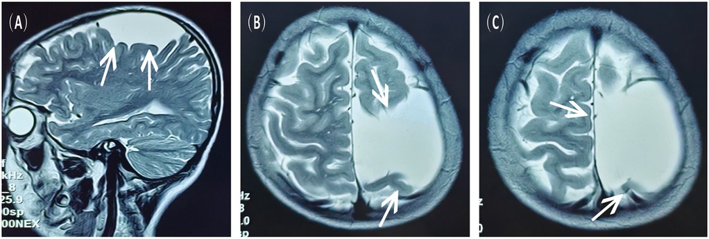Three-panel image showing MRI scans of a brain with white arrows pointing to specific areas. Panel A shows a sagittal view. Panels B and C show axial views, each highlighting different brain regions. All panels appear to focus on areas with abnormal structures or features in the brain tissue.