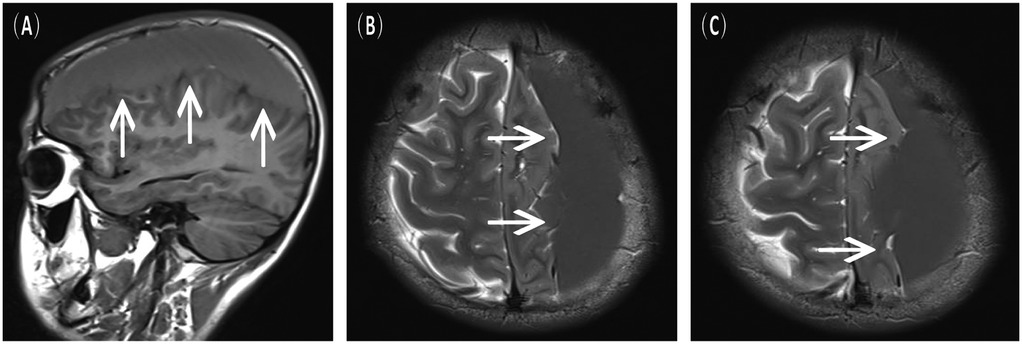 Three MRI scans of a brain. Panel A shows a sagittal view with three upward arrows indicating structures. Panel B presents an axial view with two horizontal arrows indicating the lateral ventricles. Panel C displays another axial view with two horizontal arrows pointing to altered brain tissue.