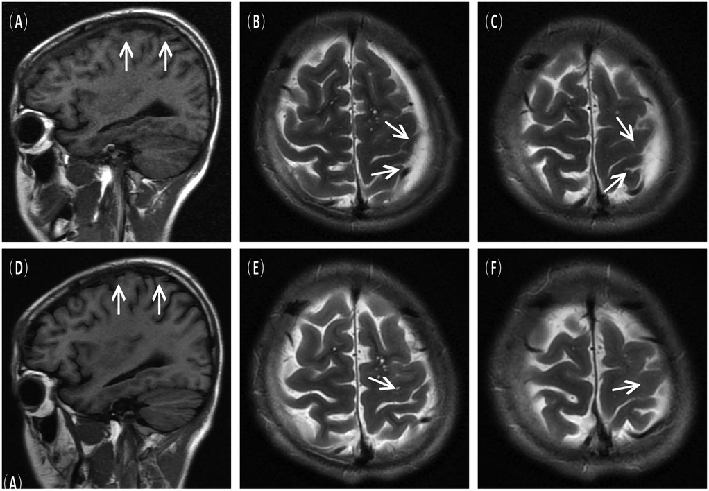 An array of six MRI brain scans labeled A to F. Images A and D show sagittal views with arrows indicating the cortical region. Images B, C, E, and F display axial views marked by arrows highlighting specific areas in the brain.