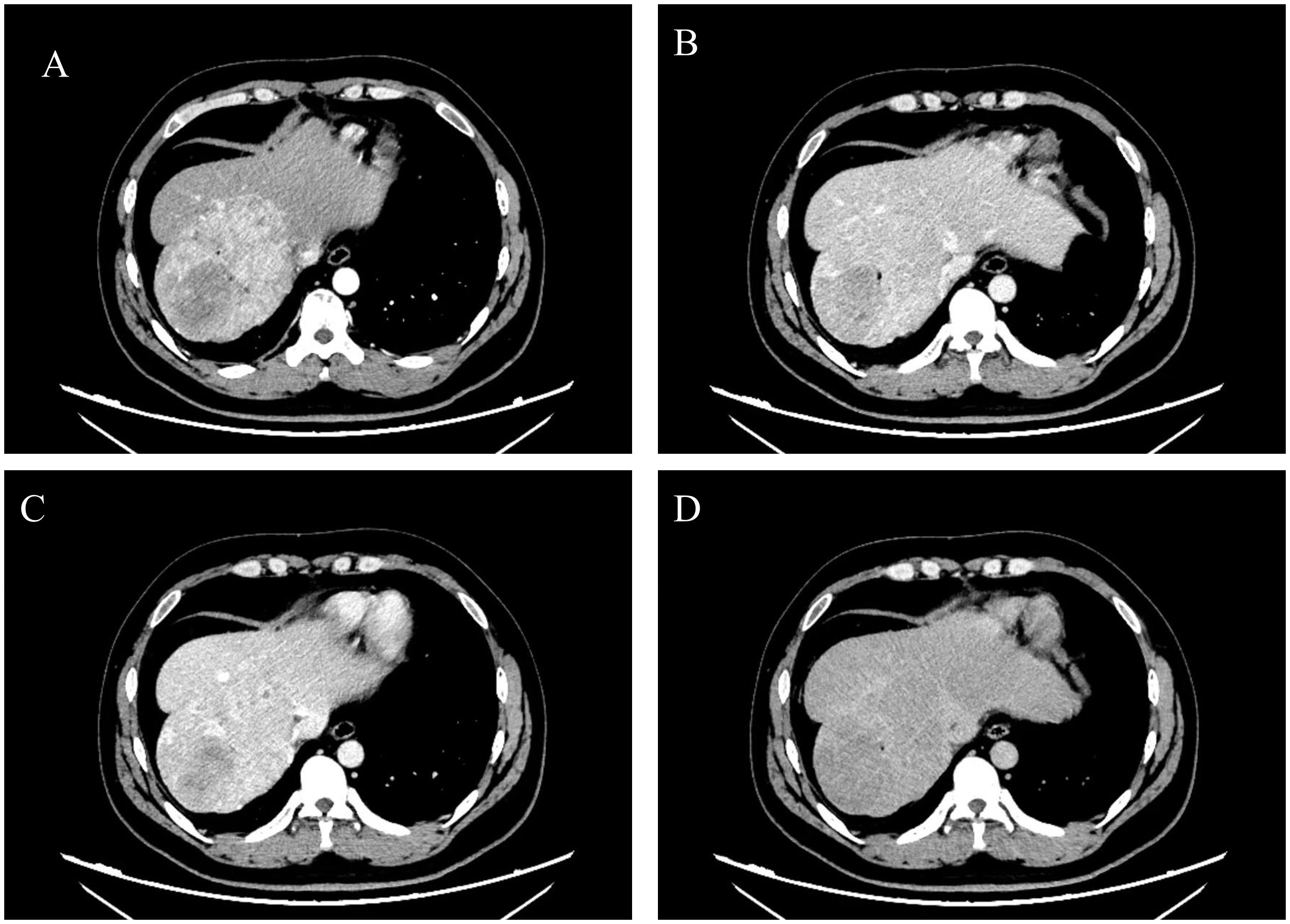 CT scan images labeled A, B, C, and D show cross-sectional views of the abdomen. The scans reveal variations in tissue density and structure, indicating different phases or conditions of an organ, likely the liver. Each image displays differences in contrast and shading, suggesting different stages or techniques in imaging.