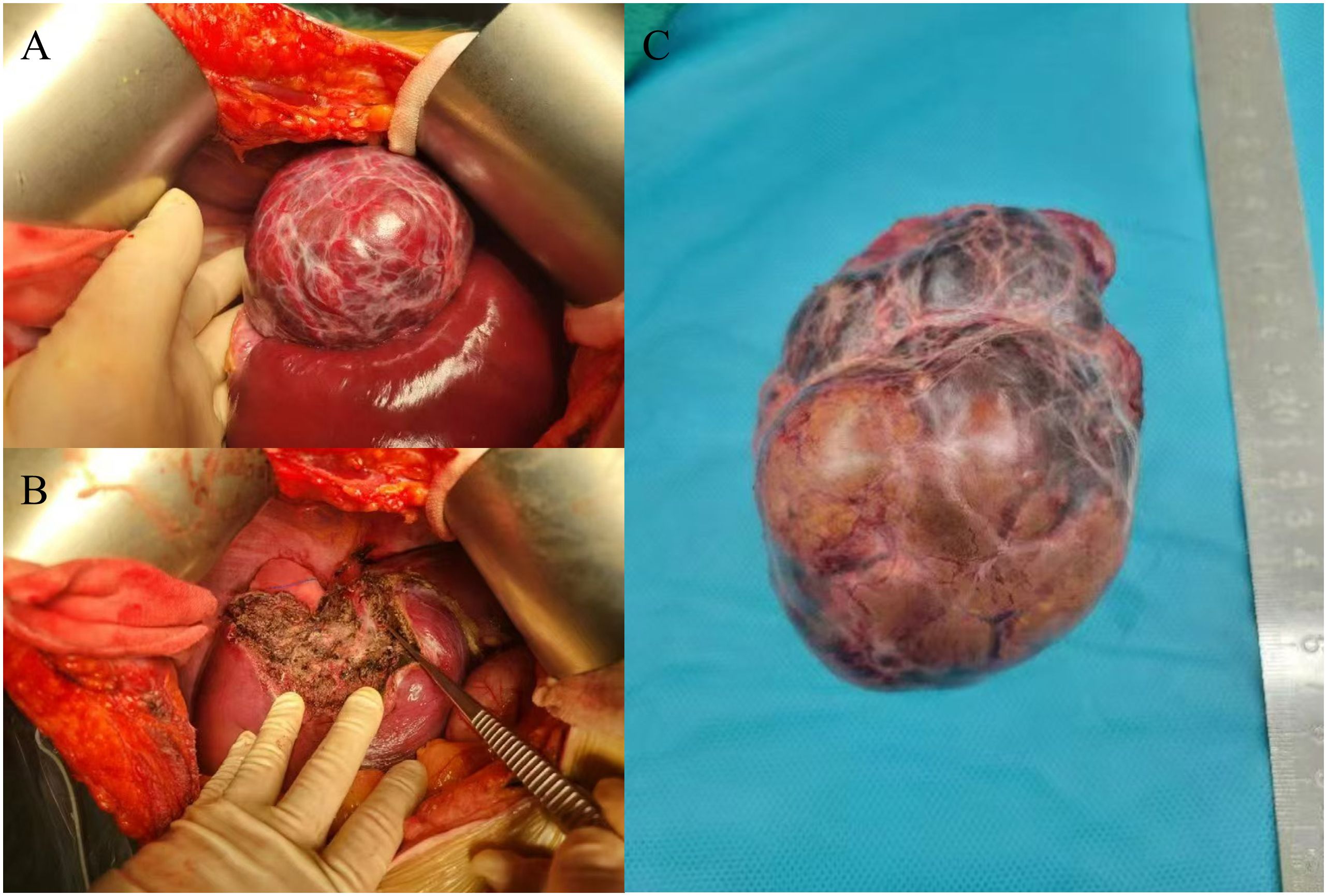 Panel A shows a surgical view of a liver with a large, round mass being exposed. Panel B captures the removal area after mass excision with surgical tools and gauze visible. Panel C displays the excised mass on a blue surgical cloth next to a ruler for scale, highlighting its size and texture.