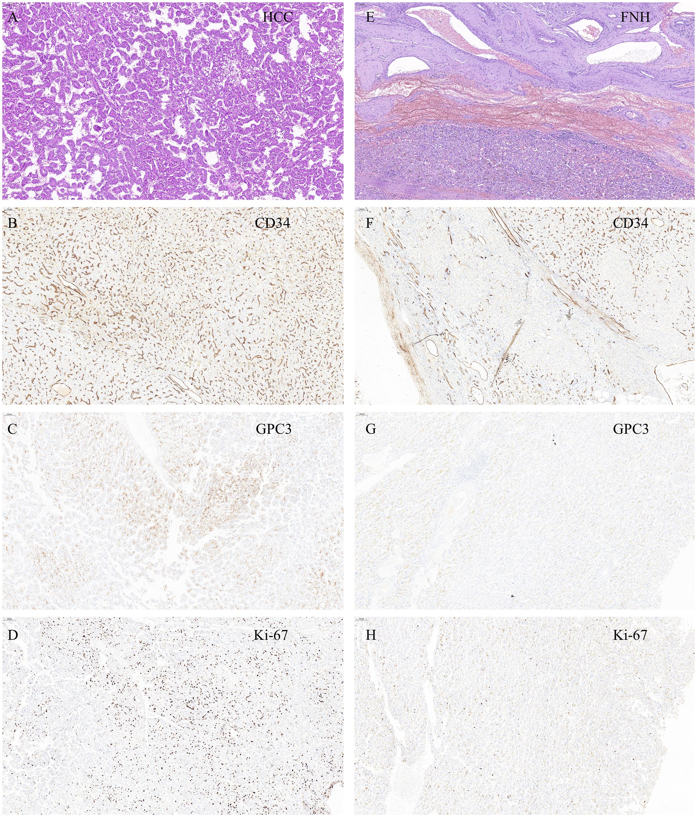 Histological images of liver tissues showing comparisons between hepatocellular carcinoma (A-D) and focal nodular hyperplasia (E-H). Panels A and E show general histology. Panels B and F display CD34 expression. Panels C and G illustrate GPC3 levels. Panels D and H depict Ki-67 staining. Each row demonstrates specific marker expression for the two different liver conditions.
