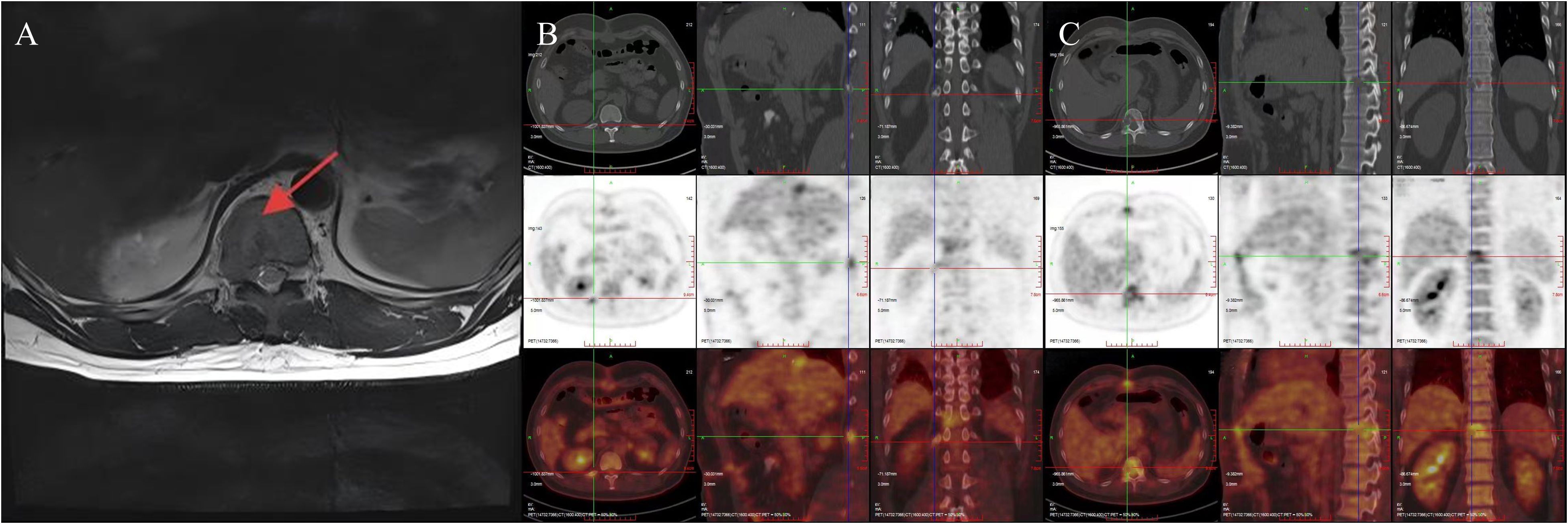 MRI and PET/CT images show various cross-sectional views of the upper body. Panel A displays an MRI with a red arrow indicating a highlighted area. Panels B and C show multiple PET/CT images in axial, sagittal, and coronal views with crosshairs used for alignment.