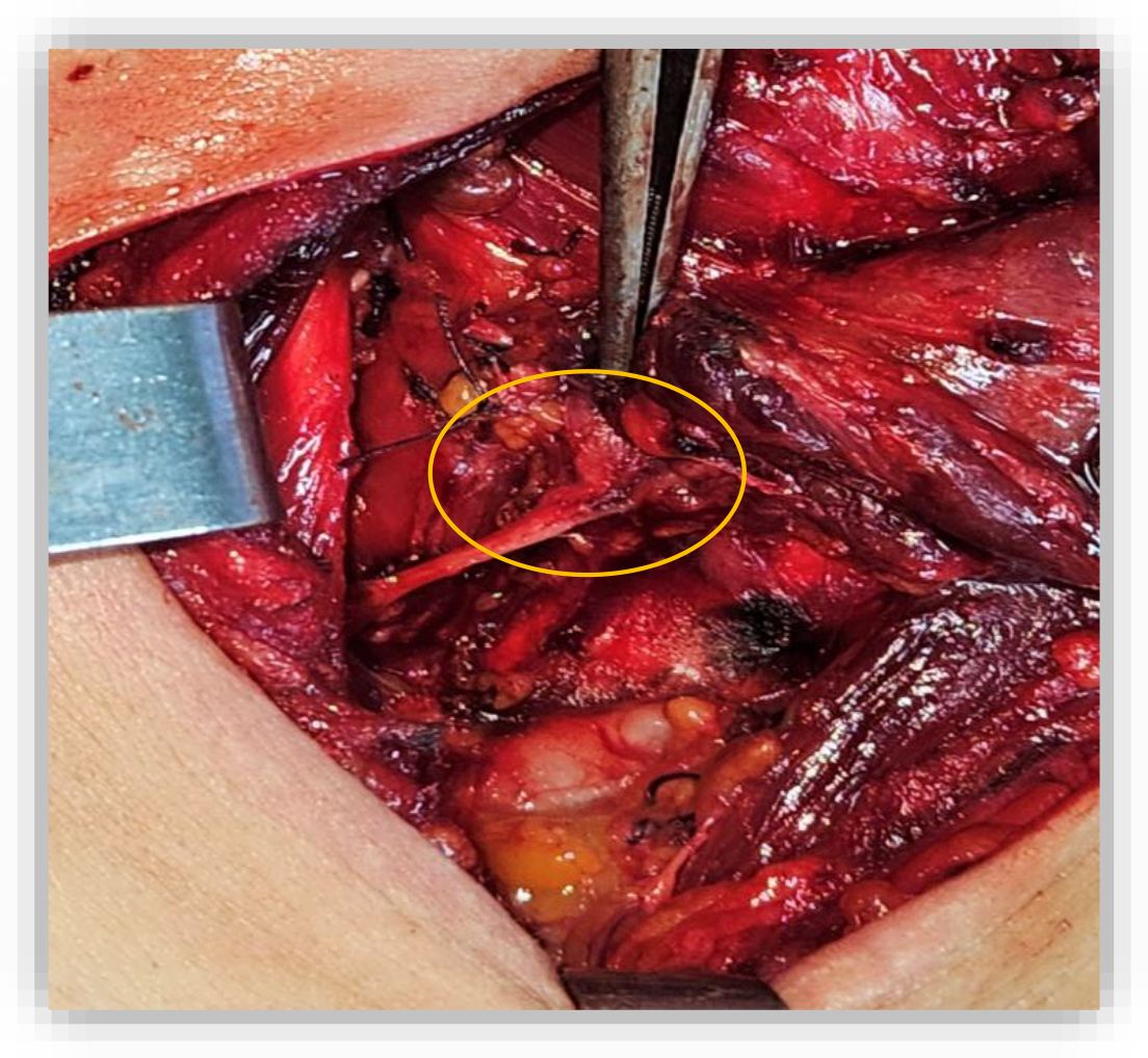 Surgical view showing an incision with exposed tissues. Two metal instruments hold the incision open. A yellow circle highlights a small area within the cavity. The surrounding tissues appear red and moist.