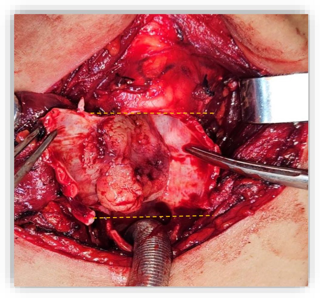 Surgical image showing an exposed area of tissue. The focus is on a section highlighted by yellow dashed lines, with surgical tools surrounding the area. The tissue appears red and complex.