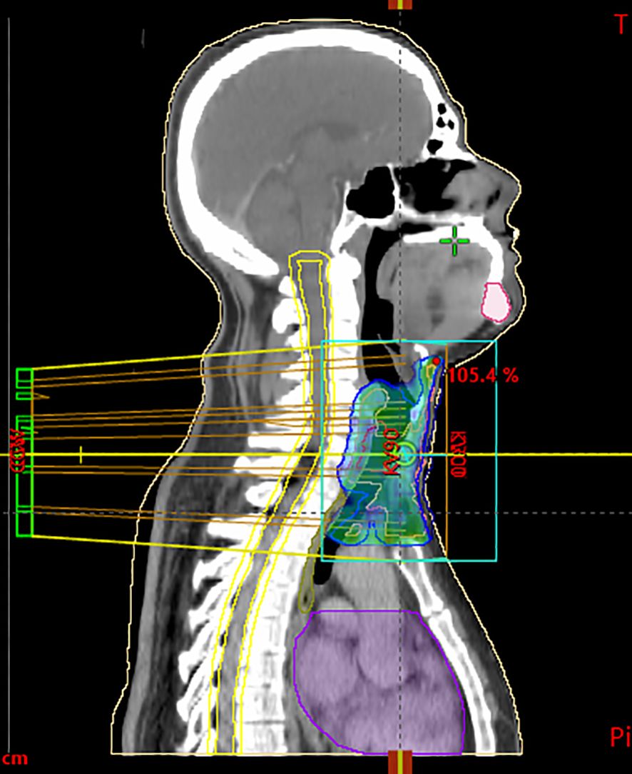 CT scan of a human head and neck in profile view with outlined regions and measurements. Colored lines and shaded areas indicate anatomical structures and targeted zones, including a highlighted percentage reading of 105.4%.