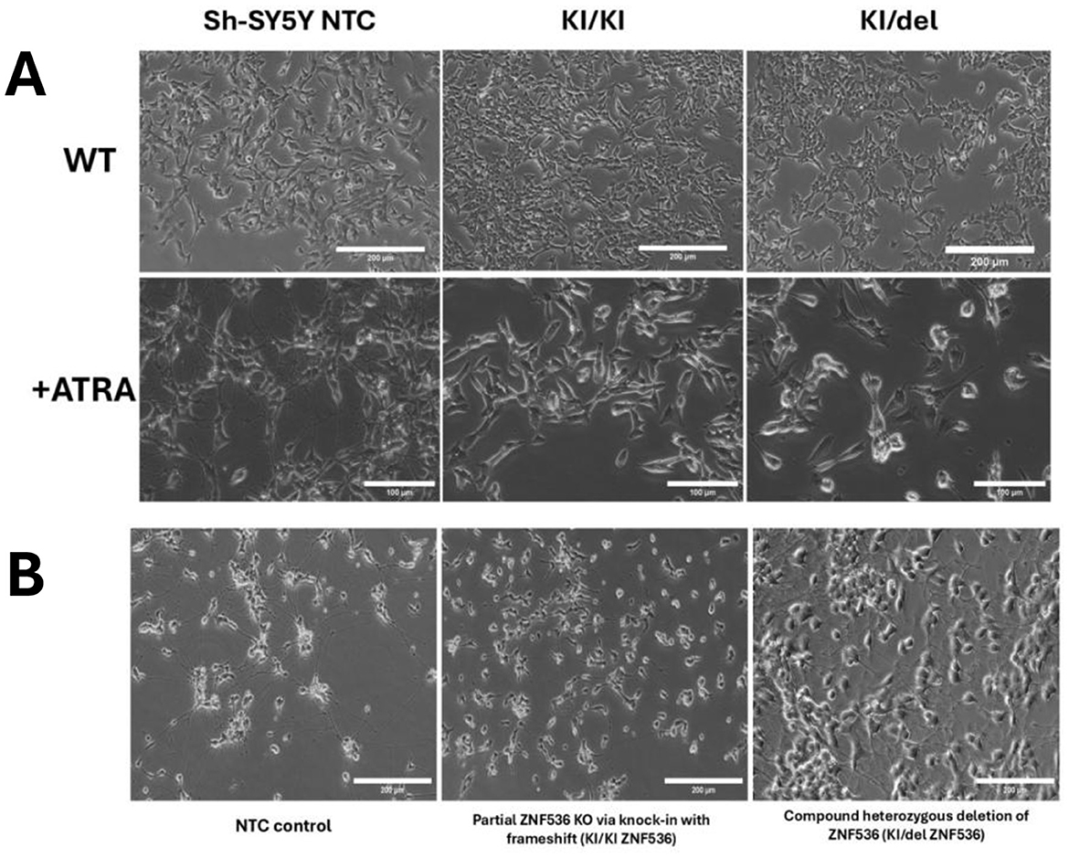 Microscopic images of cell cultures divided into two sections, A and B. Section A shows three columns labeled Sh-SY5Y NTC, KI/KI, and KI/del, with rows labeled WT and +ATRA. Section B shows similar columns labeled NTC control, Partial ZNF536 KO via knock-in with frameshift, and Compound heterozygous deletion of ZNF536. Each image shows variations in cell density and morphology. Scale bars are present in each image.