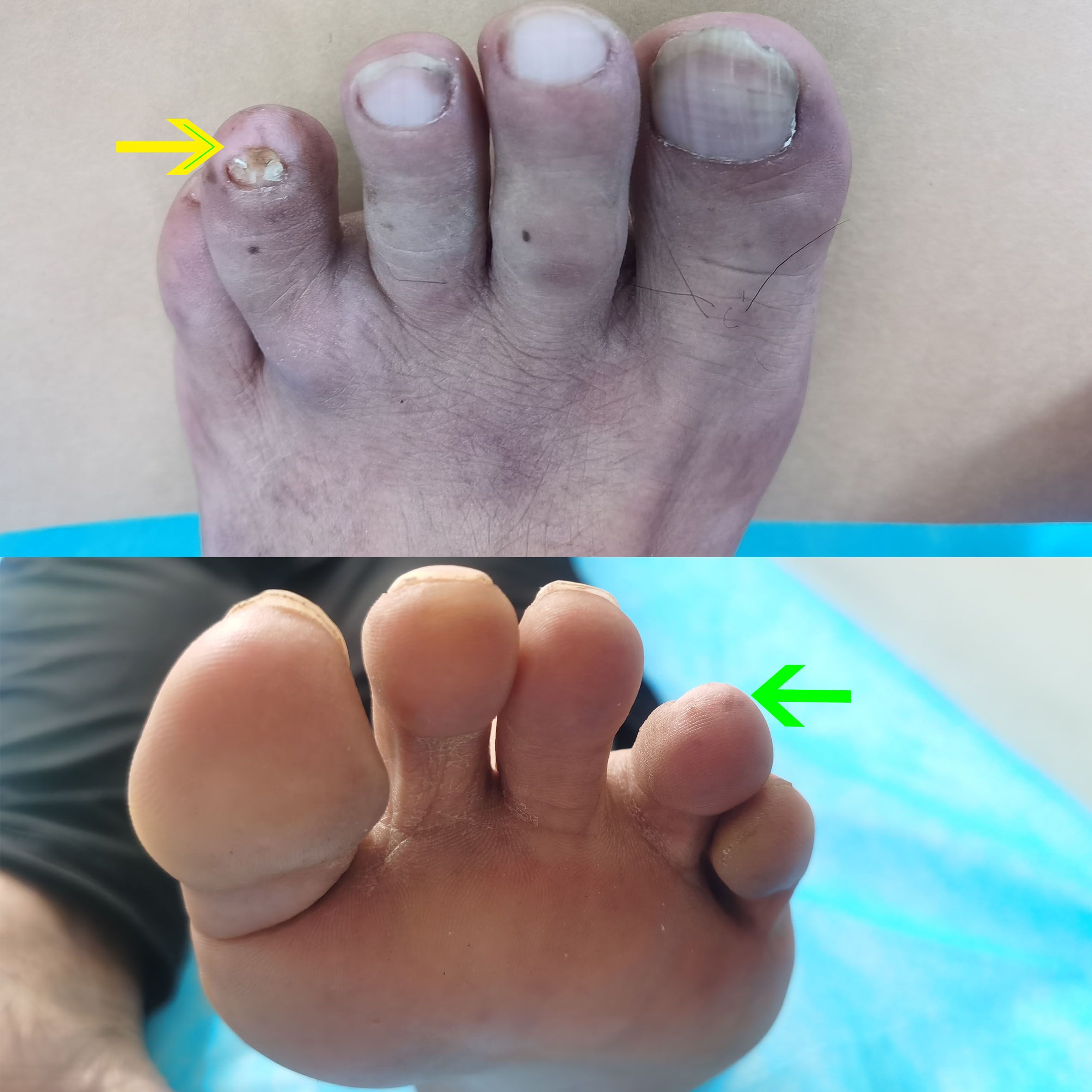 Two images of a foot. The top shows a foot with a damaged big toenail and discoloration on the toenail, highlighted by a yellow arrow. The bottom image shows the underside of the foot with a slightly swollen pinky toe, indicated by a green arrow.