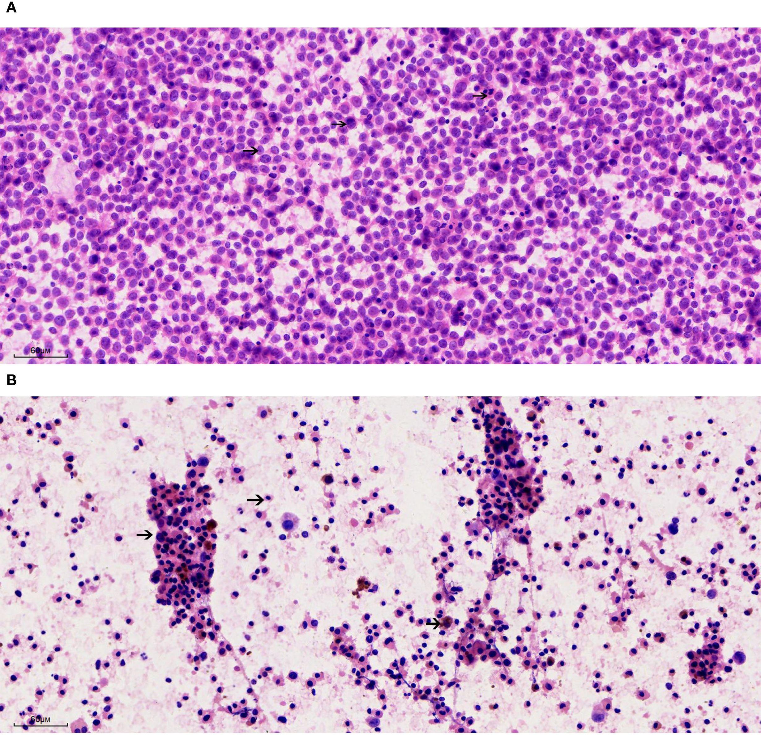 Panel A shows a dense aggregation of round cells stained purple, indicating a high cellular concentration. Panel B displays scattered purple-stained cells with clusters forming around specific areas, amidst a lighter background. Arrows point to notable features in both images.