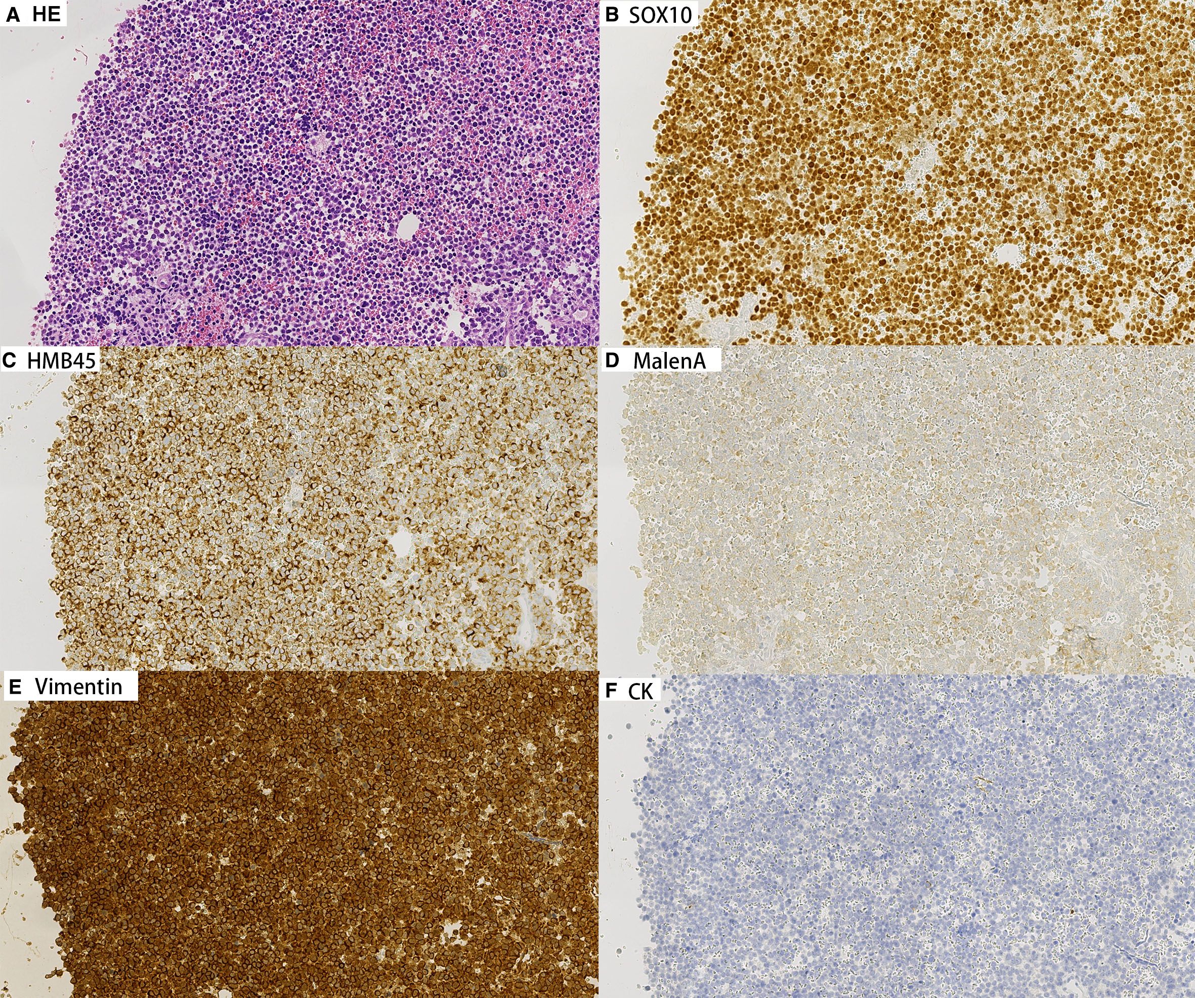 Composite image of six immunohistochemical slides labeled A to F. A: HE stain shows densely packed purple and pink cells. B: SOX10 stain presents brown, positive cells. C: HMB45 shows a diffuse brown reaction. D: MalenA displays a lighter, less intense expression. E: Viment shows dark brown, intense staining. F: CK exhibits light blue, negative staining.