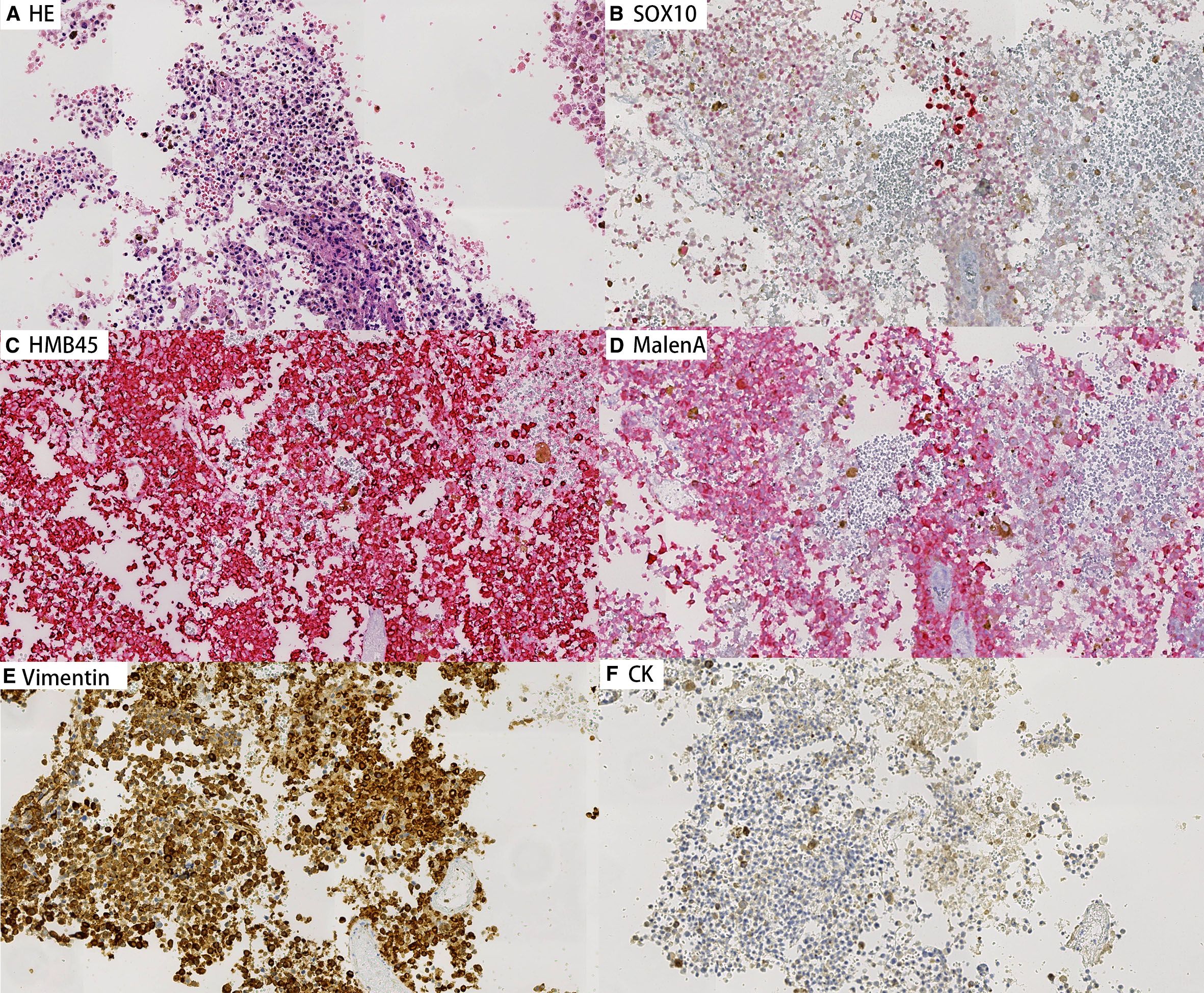 Microscopic views of tissue samples stained with various markers. A: Hematoxylin and eosin staining shows densely packed purple cells. B: SOX10 staining highlights specific nuclear regions. C: HMB45 staining shows prominent red areas. D: MelanA staining reveals scattered red patterns. E: Vimentin staining shows brown cell clusters. F: CK staining with lighter brown shades and scattered cells.