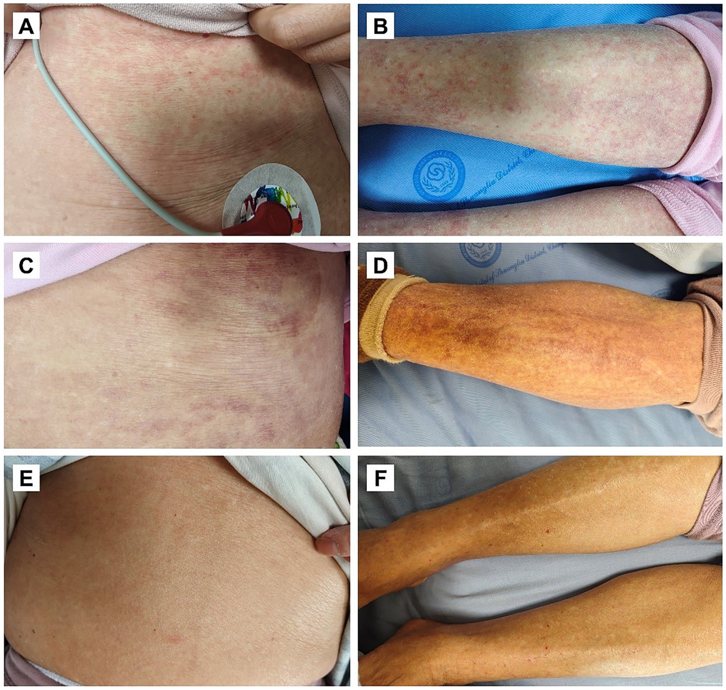 A group of six images labeled A to F, displaying skin conditions and changes after treatment. A and B show a rash with red spots on the skin. C and D depicts skin with relieved rash on the abdomen and left limb. E and F presents smooth skin with minor blemishes.