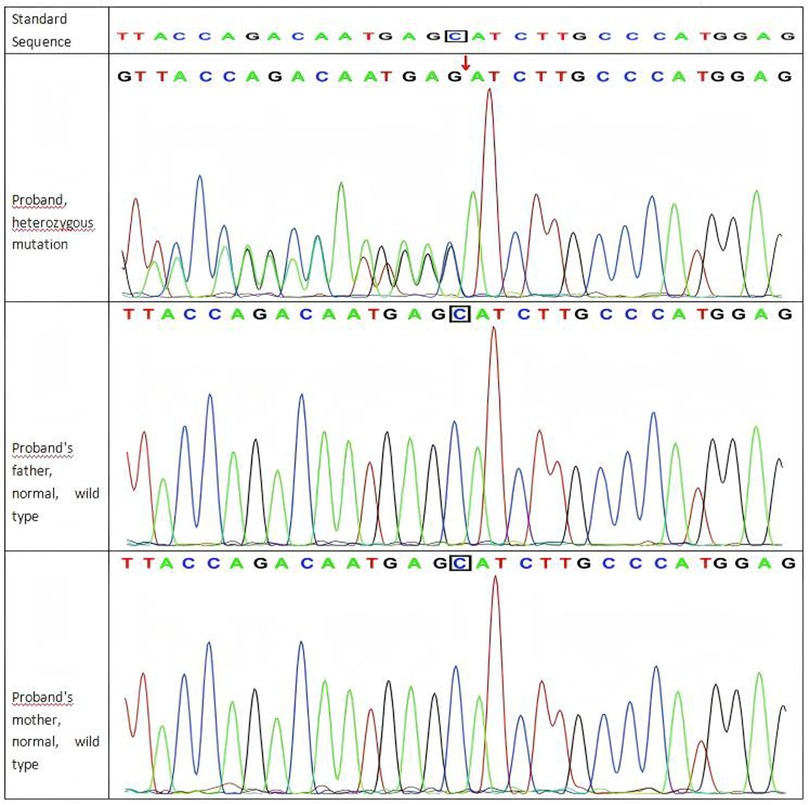 DNA sequence chromatographs comparing a standard sequence with those of a proband and their parents. The top chromatograph shows the proband's sequence with a heterozygous mutation indicated by a red arrow. The middle and bottom chromatographs show the sequences from the proband's father and mother, respectively, both displaying normal, wild type sequences. Each chromatograph includes colored peaks corresponding to nucleotide bases: adenine (A), cytosine (C), guanine (G), and thymine (T).