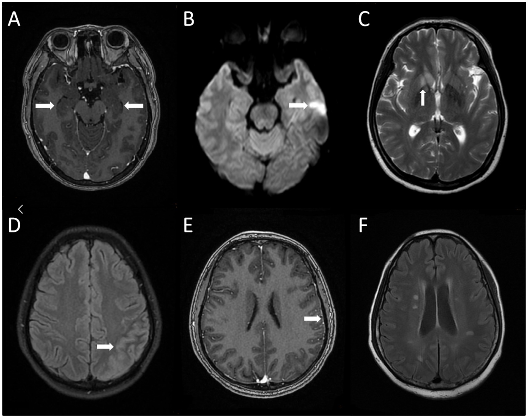 MRI brain scans labeled A to F. A shows bilateral signal changes in the temporal lobes. B displays diffusion-weighted imaging with a bright area in the cerebellum. C highlights a lesion in the thalamus. D shows a cortical lesion. E presents abnormal signal intensities in the frontal lobe. F appears as a normal reference scan. Arrows indicate specific abnormalities.