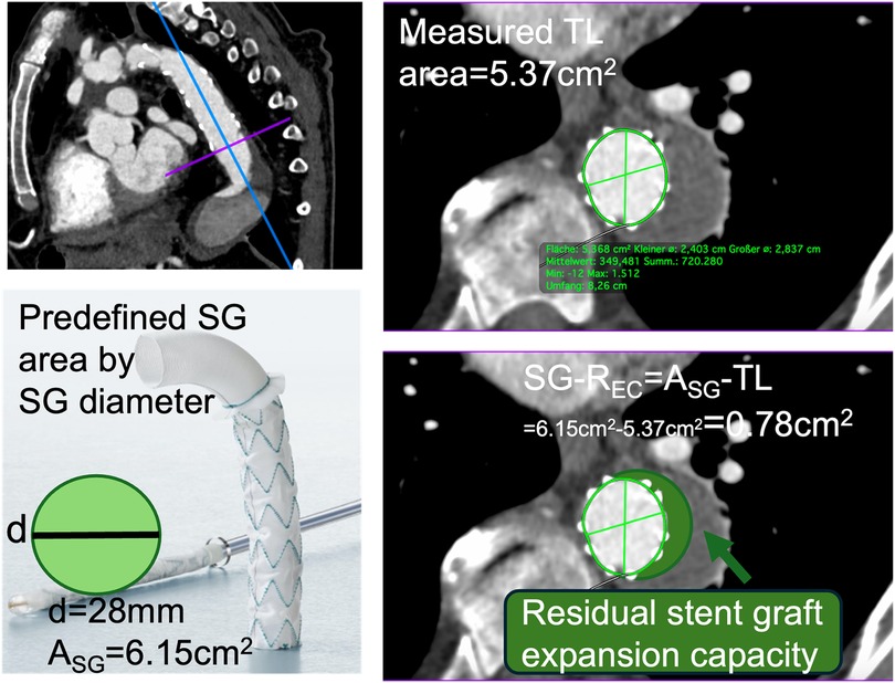 Illustration of the measurements or the stent graft expansion capacity (SG-REC). Top left shows cross-sectional CTA image with measurement lines of 3D multiplanar reconstruction. Top right shows measured the true lumen (TL) area of 5.37 cm². Bottom left shows a schematic of the stent graft with predefined area (ASG = 6.15 cm²) derived from a diameter of 28 mm. Bottom right includes the calculation of the residual stent graft expansion capacity (SG-REC = ASG - TL = 0.78 cm²), highlighting the difference between device area and true lumen area and reflecting the remaining expansion potential after SG deployment.