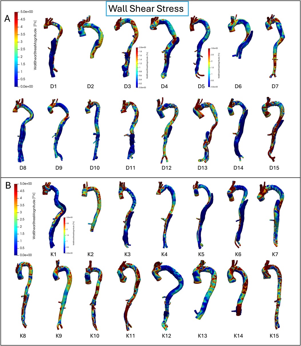 Thirty 3D aortic models displaying the results from the CFD simulations are shown in two rows: A (dSINE group, D1-D15) and B (control group, K1-K15). Each model depicts vascular geometry with wall shear stress (WSS) distribution on a blue-to-red scale, where blue indicates low and red high values. In the dSINE group, elevated WSS is particularly evident in regions distal to the stent graft, whereas the control group demonstrates more uniform and stable WSS patterns.