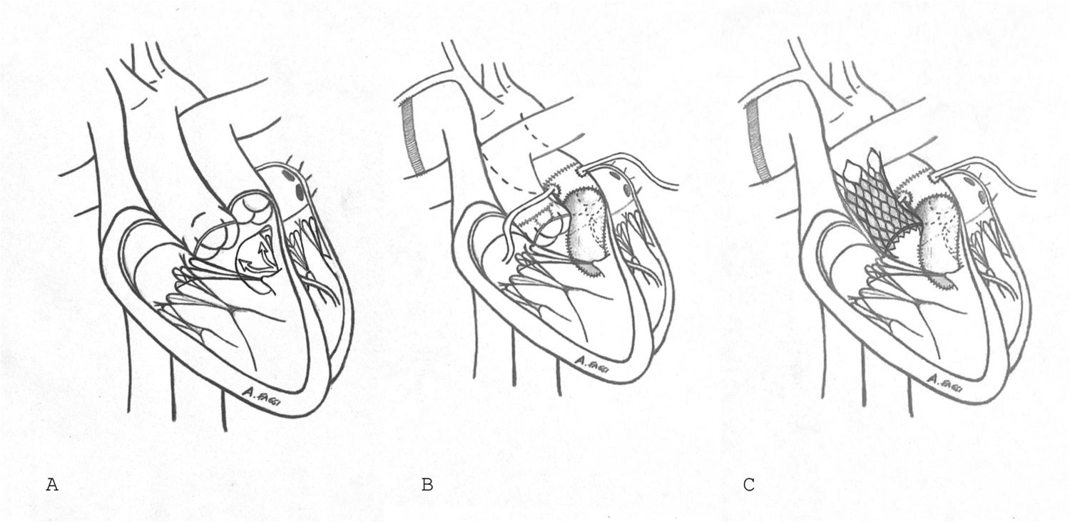 Diagram showing three stages of a surgical procedure on the heart. Panel A depicts the initial step with a clear view of the heart chambers and an open valve. Panel B shows surgical intervention with devices inserted and partial closure. Panel C illustrates the final step with a mesh structure supporting the valve and complete closure. Each stage demonstrates a progressive surgical technique.
