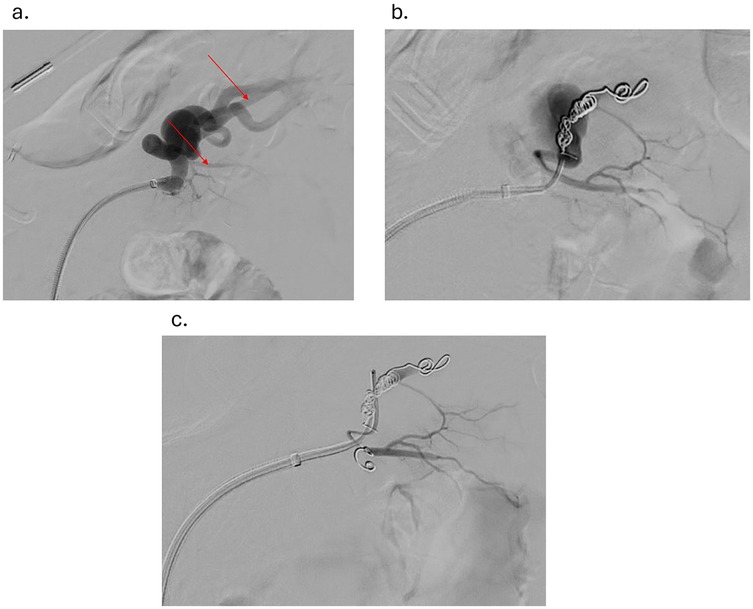 Angiographic images showing three stages of an embolization procedure. (a) Initial image with two red arrows indicating branches originating from splenic artery aneurysm. (b) Mid-procedure image displaying a coiled structure within the vessel, suggesting embolization progress. (c) Final image showing completed embolization with more coiling and reduced branching vessels visibility.