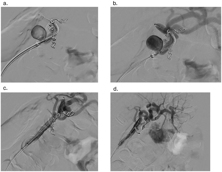 Angiographic images showing four stages in coiling a vascular structure. Image (a) and (b) depict coils being deployed in a vessel. Image (c) shows full deployment with a stent. Image (d) reveals post-procedure blood flow changes.