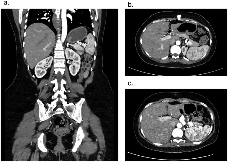 CT scan images showing different views of the abdomen. Image a shows a coronal section highlighting the proper perfusion of the spleen on follow-up. Images b and c display axial sections of the abdomen, revealing internal structures and stent patency allowing adequate perfusion to the spleen at 3 and 6 months.