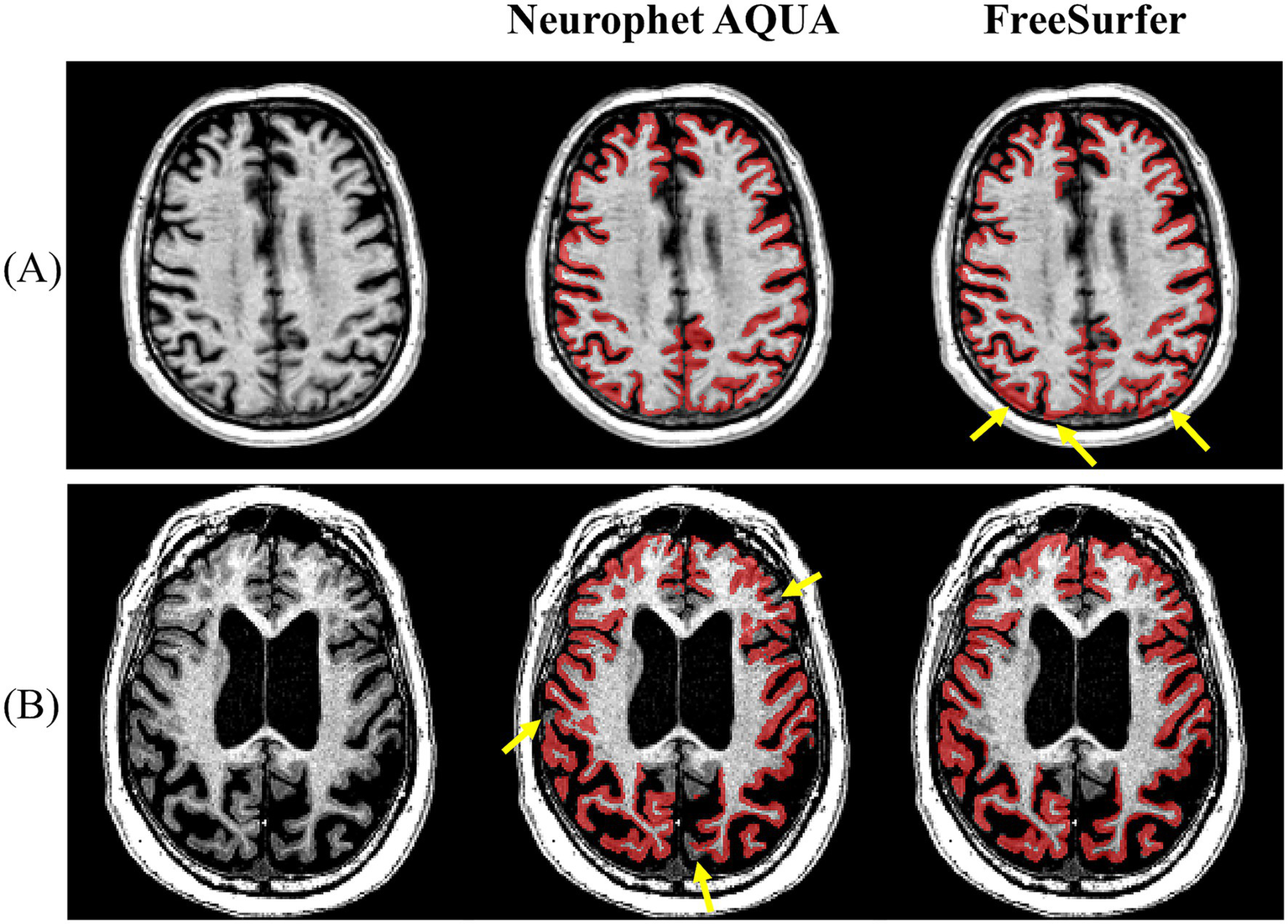 Two sets of MRI brain images labeled A and B illustrate gray matter, white matter, and cerebrospinal fluid boundary segmentation produced by Neurophet AQUA and FreeSurfer. Each row shows the raw MRI scan, the AQUA output, and the FreeSurfer output. The figure demonstrates case-dependent differences in boundary delineation between the two methods. Yellow arrows indicate regions in each panel where boundary inaccuracies or mis-segmentation occur, highlighting areas in which the segmentation results differ between AQUA and FreeSurfer.