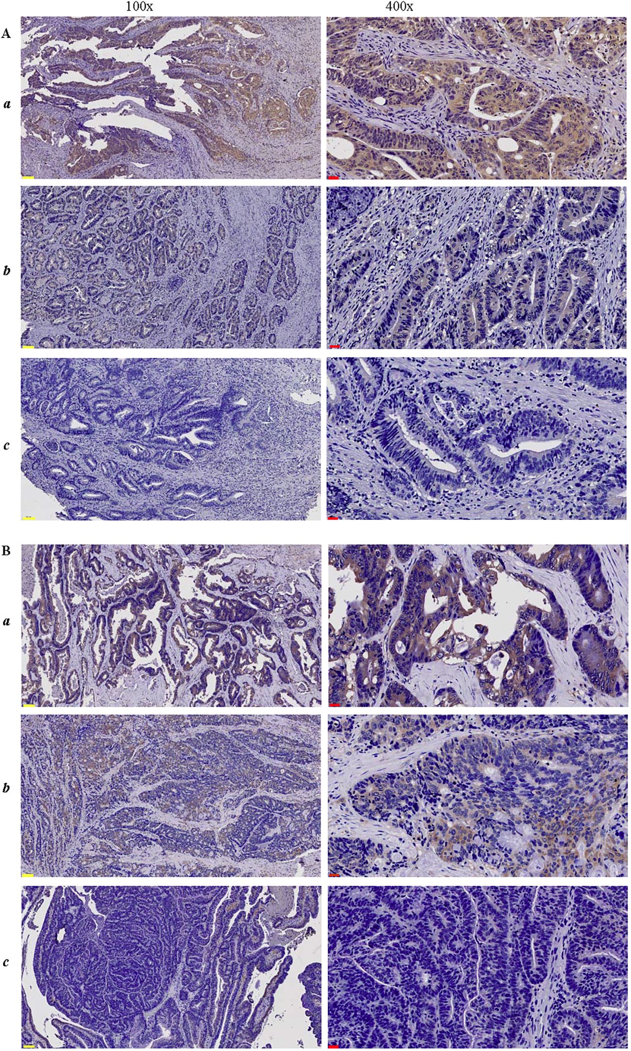 Microscopic images show tissue samples at two magnifications, 100x and 400x. Panel A and B each contain three rows labeled “a”, “b”, and “c”, displaying various tissue staining patterns. Panel A features a mix of brown and blue staining, with increasing cellular detail from left to right. Panel B shows more defined tissue structures with dark staining against a lighter background. Each row within the panels reveals different histological characteristics, indicating variations in cell morphology and staining intensity.