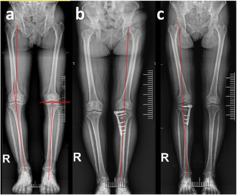 Three X-ray panels labeled a, b, and c show a lower limb with red alignment lines. Panel a displays a misalignment in the right leg. Panels b and c show post-operative images with surgical plates and improved alignment.