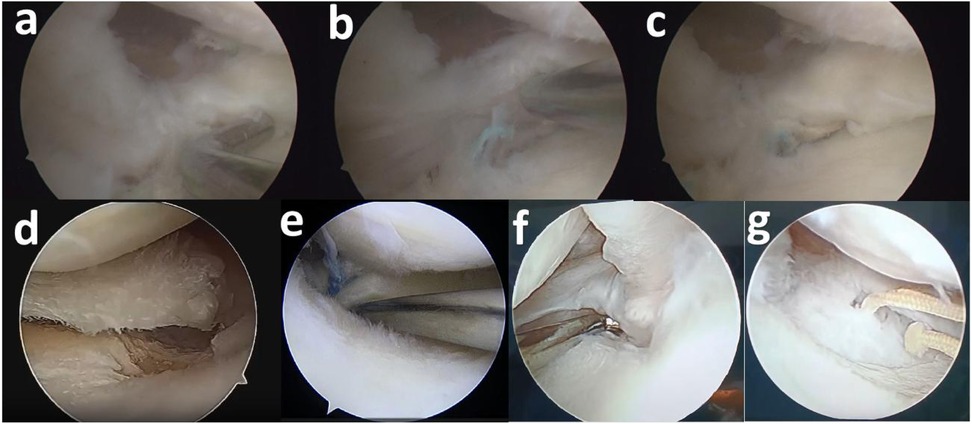 Seven arthroscopic images labeled a to g show various stages and perspectives of a surgical procedure involving soft tissue and cartilage. Each image reveals different tools and anatomical features, including incisions and fiber structures, indicative of a knee joint intervention. The images likely represent different steps such as inspection, incision, and repair, showcasing the intricate details of the surgical environment.