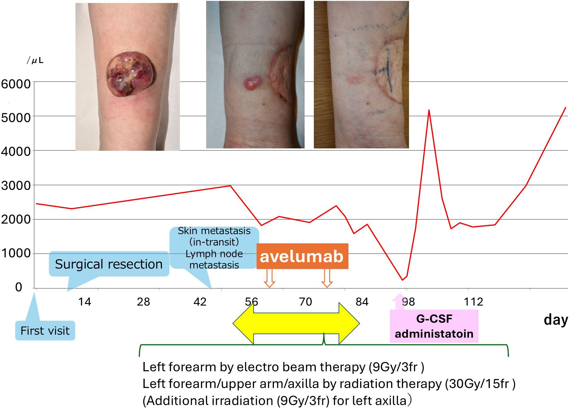 A graph shows white blood cell counts over time, with annotations for treatments: surgical resection, avelumab administration, and G-CSF administration. Images of a forearm with skin conditions are above the graph, showing progression from a large lesion to post-treatment healing. Labels indicate skin metastasis, lymph node metastasis, and radiation therapy details.