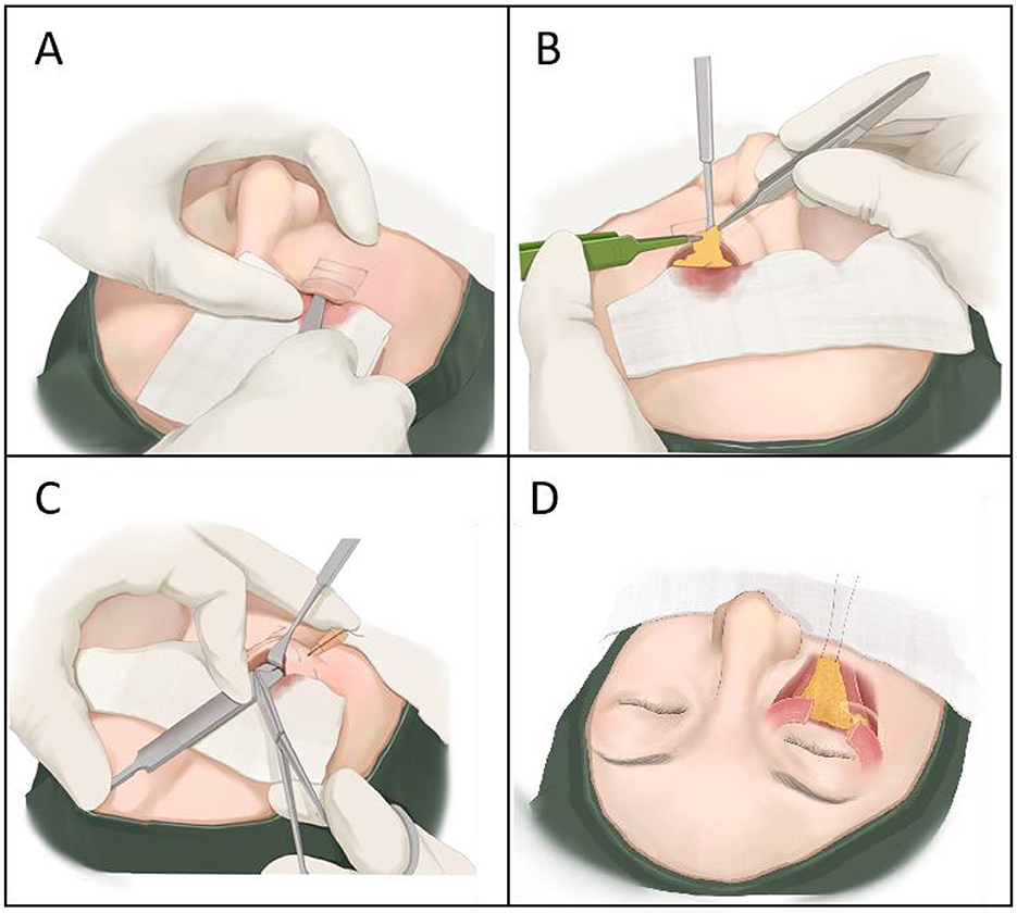 Four-panel illustration showing a surgical procedure on a nose. Panel A: An incision is made inside the nasal cavity. Panel B: Surgical tools manipulate the exposed area. Panel C: Further adjustment with tools inside the nose. Panel D: The result shows the structure of the nose with guided lines, suggesting reconstruction.