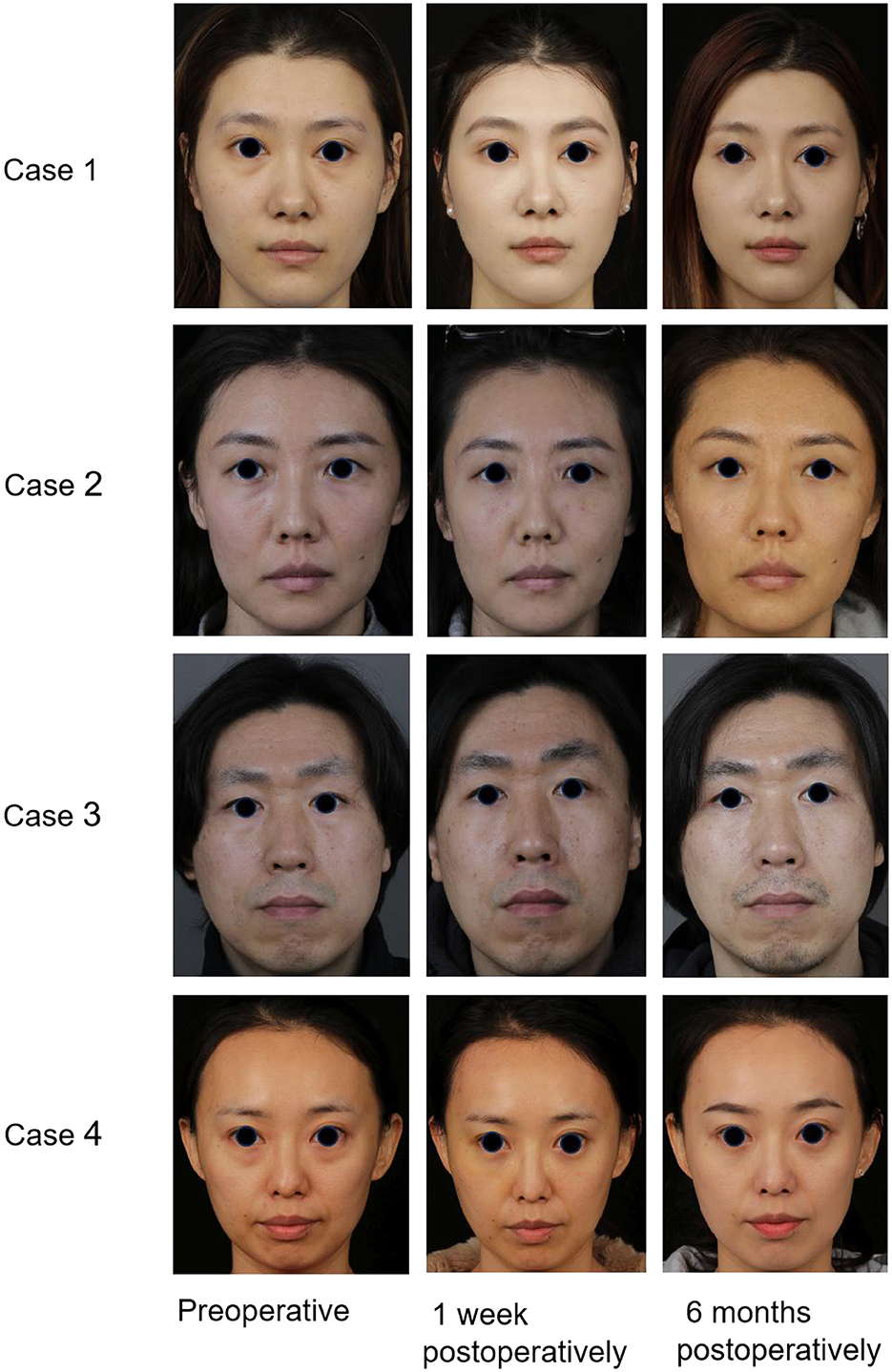 Four cases showing preoperative, one week postoperative, and six months postoperative frontal portraits. Each row corresponds to a different case, demonstrating facial changes over time.