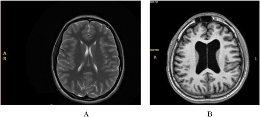 MRI brain scans showing two axial views. Image A displays a brain with standard features, including visible gyri and sulci. Image B highlights enlarged ventricles, indicating possible medical conditions such as hydrocephalus.