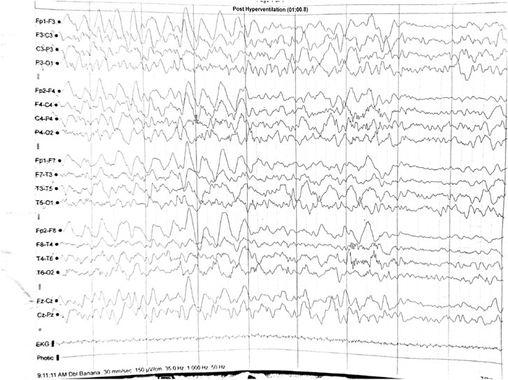 An electroencephalogram (EEG) readout showing multiple wave patterns across various channels, labeled from Fp1-F3 to Cz-Pz. The recording is noted as
